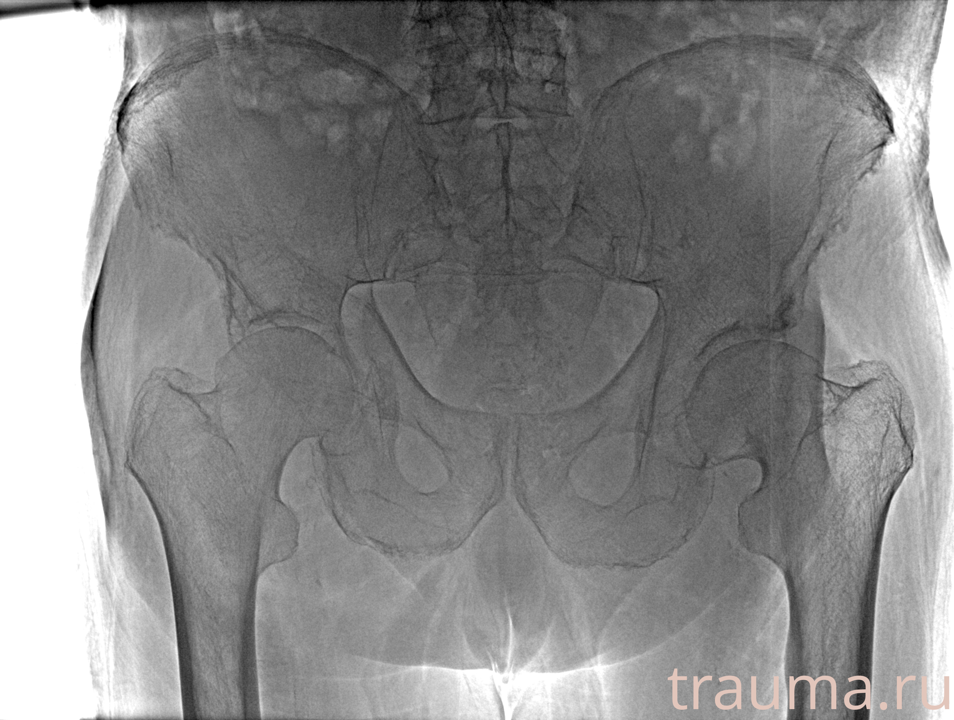 Рентген на дому: по вашему адресу приезжает врач-рентгенолог, травматолог-ортопед с мобильным рентгеновским аппаратом, проводит диагностику травмы или заболевания, делает необходимые рентгенограммы, дает рекомендации по дальнейшему лечению. Получить качественные снимки в домашних условиях возможно благодаря уникальной методике, разработанной МосРентген Центром для института  Склифосовского