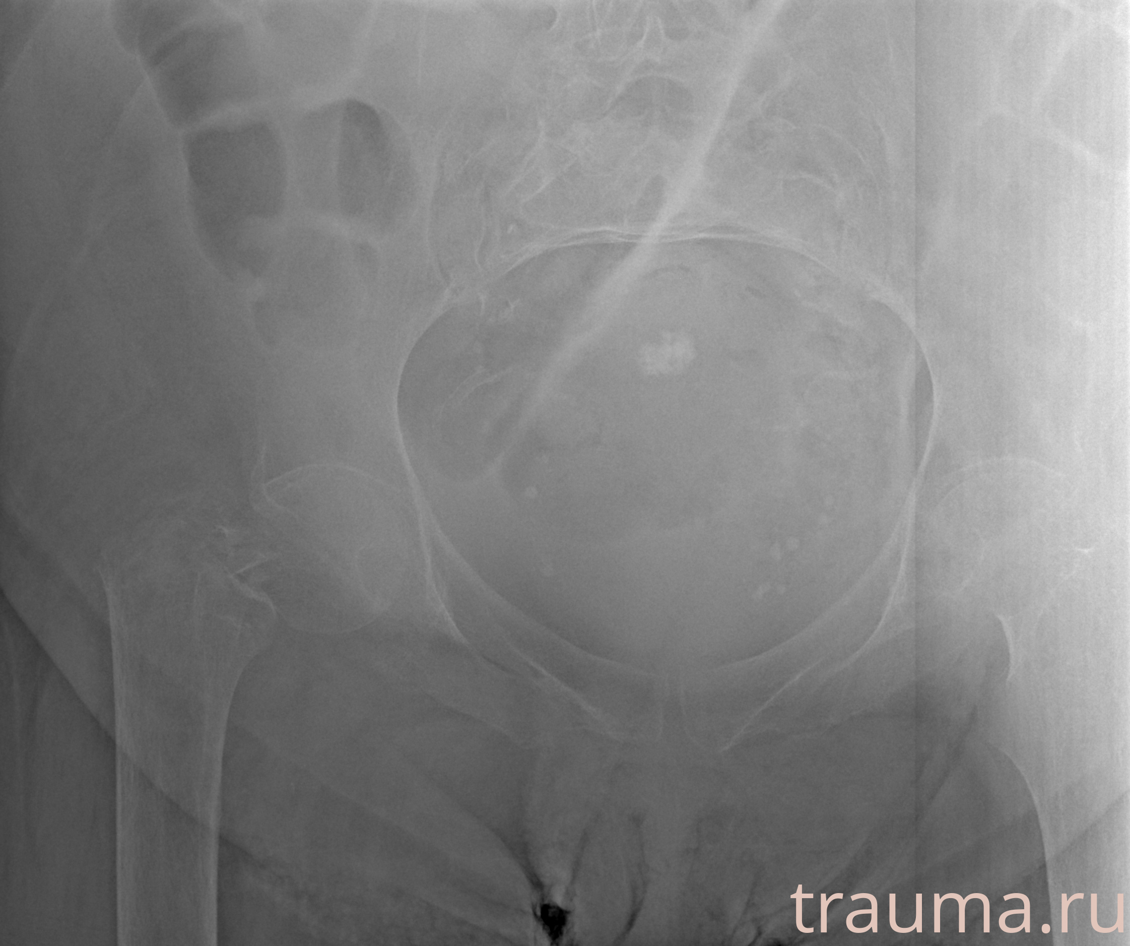 Рентген на дому: по вашему адресу приезжает врач-рентгенолог, травматолог-ортопед с мобильным рентгеновским аппаратом, проводит диагностику травмы или заболевания, делает необходимые рентгенограммы, дает рекомендации по дальнейшему лечению. Получить качественные снимки в домашних условиях возможно благодаря уникальной методике, разработанной МосРентген Центром для института  Склифосовского