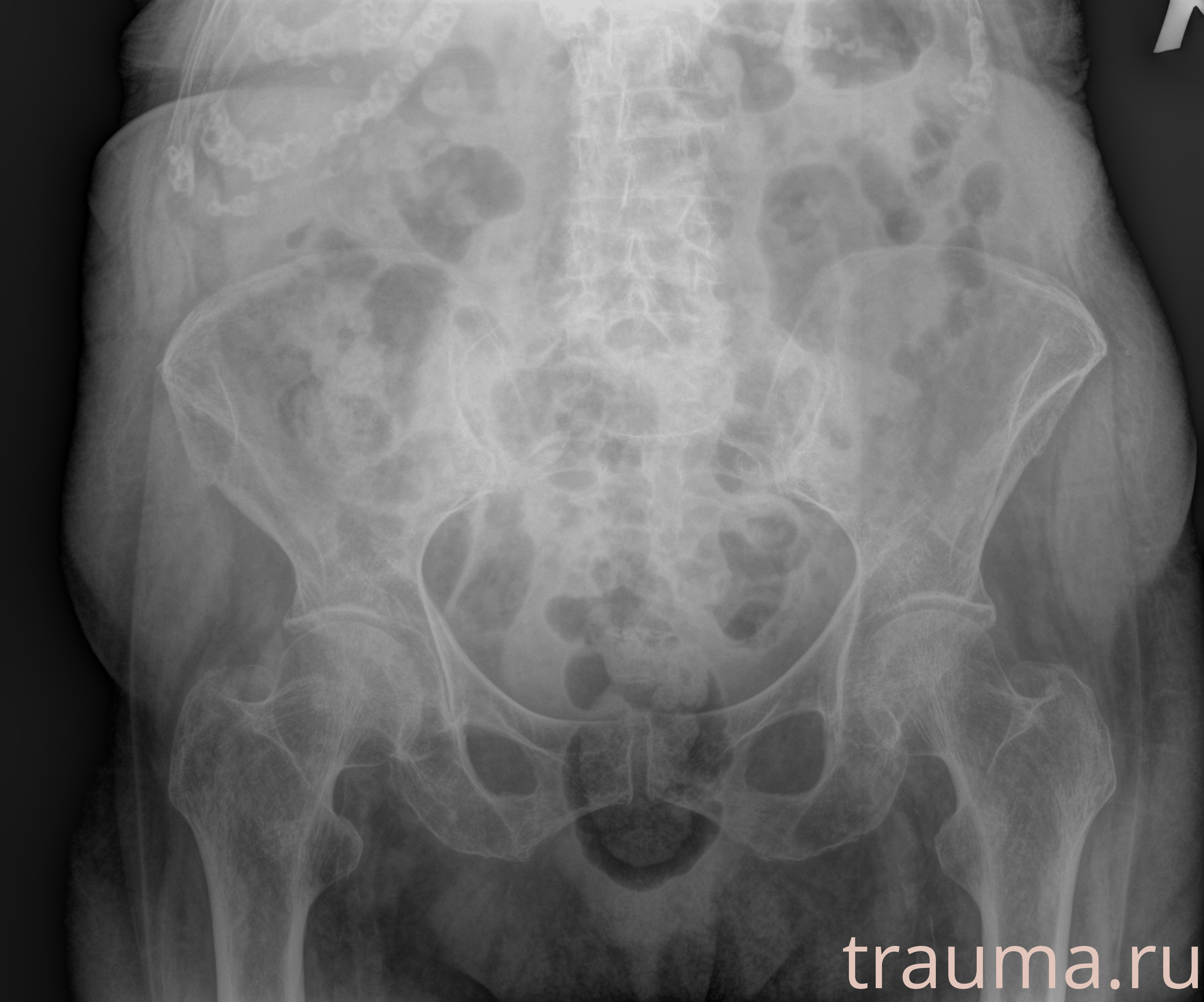 Рентген на дому: по вашему адресу приезжает врач-рентгенолог, травматолог-ортопед с мобильным рентгеновским аппаратом, проводит диагностику травмы или заболевания, делает необходимые рентгенограммы, дает рекомендации по дальнейшему лечению. Получить качественные снимки в домашних условиях возможно благодаря уникальной методике, разработанной МосРентген Центром для института  Склифосовского