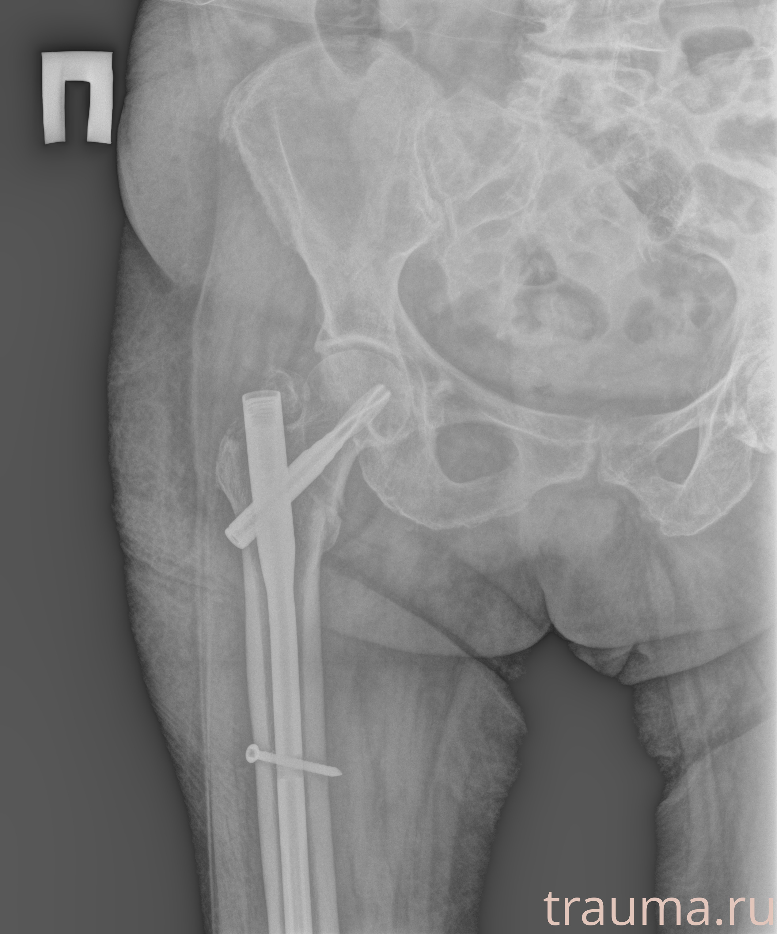 Рентген на дому: по вашему адресу приезжает врач-рентгенолог, травматолог-ортопед с мобильным рентгеновским аппаратом, проводит диагностику травмы или заболевания, делает необходимые рентгенограммы, дает рекомендации по дальнейшему лечению. Получить качественные снимки в домашних условиях возможно благодаря уникальной методике, разработанной МосРентген Центром для института  Склифосовского