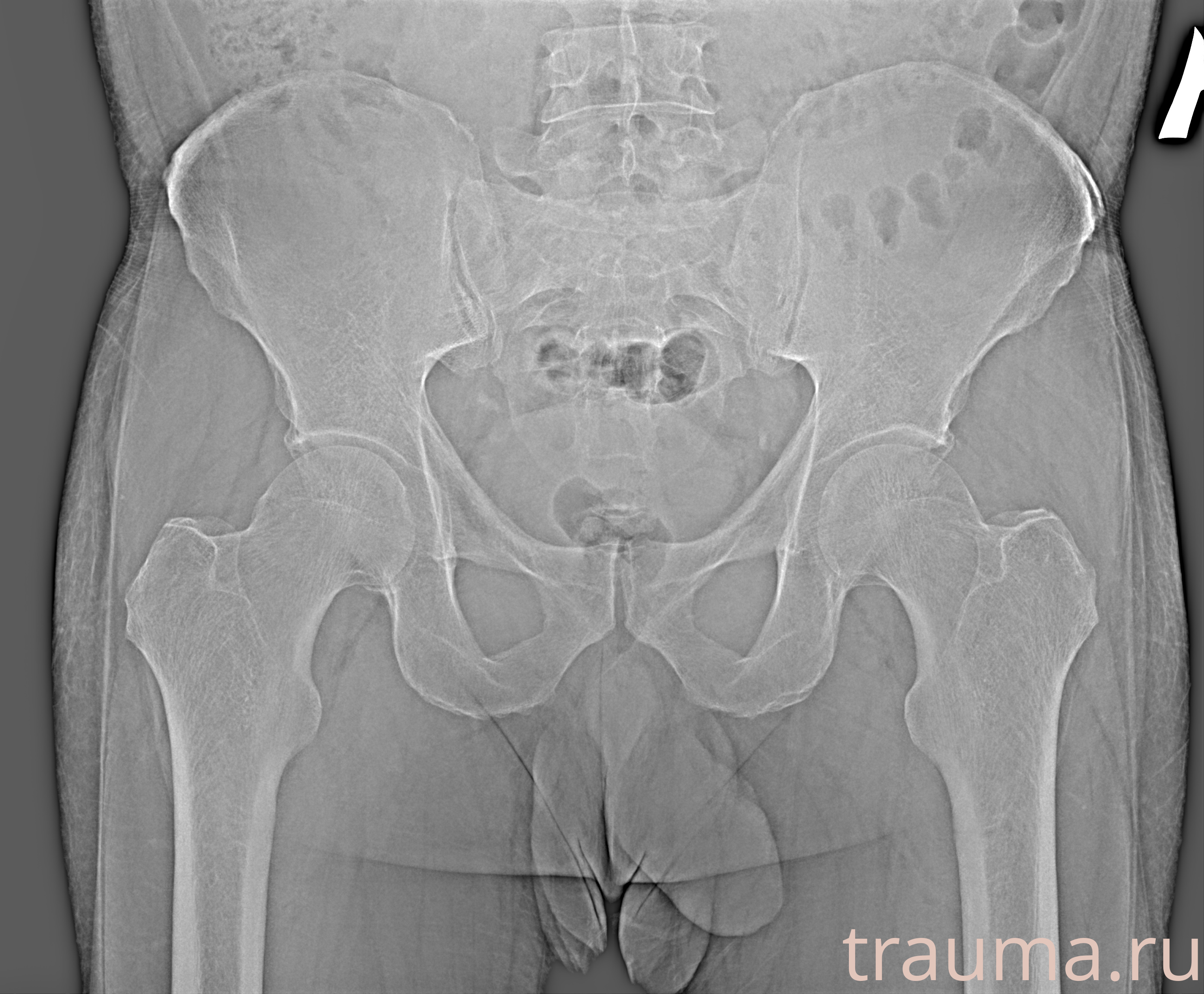 Рентген на дому: по вашему адресу приезжает врач-рентгенолог, травматолог-ортопед с мобильным рентгеновским аппаратом, проводит диагностику травмы или заболевания, делает необходимые рентгенограммы, дает рекомендации по дальнейшему лечению. Получить качественные снимки в домашних условиях возможно благодаря уникальной методике, разработанной МосРентген Центром для института  Склифосовского