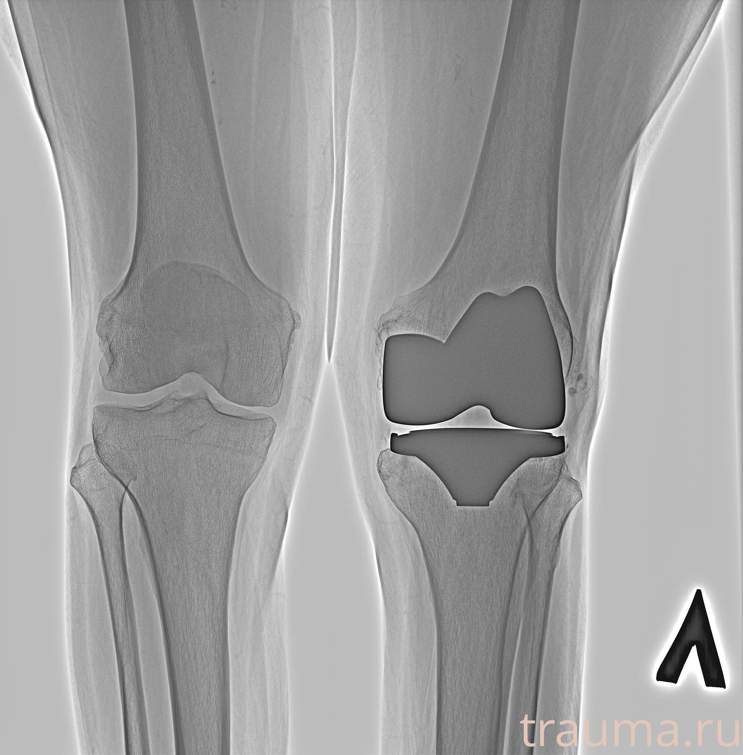 Рентген на дому: по вашему адресу приезжает врач-рентгенолог, травматолог-ортопед с мобильным рентгеновским аппаратом, проводит диагностику травмы или заболевания, делает необходимые рентгенограммы, дает рекомендации по дальнейшему лечению. Получить качественные снимки в домашних условиях возможно благодаря уникальной методике, разработанной МосРентген Центром для института  Склифосовского