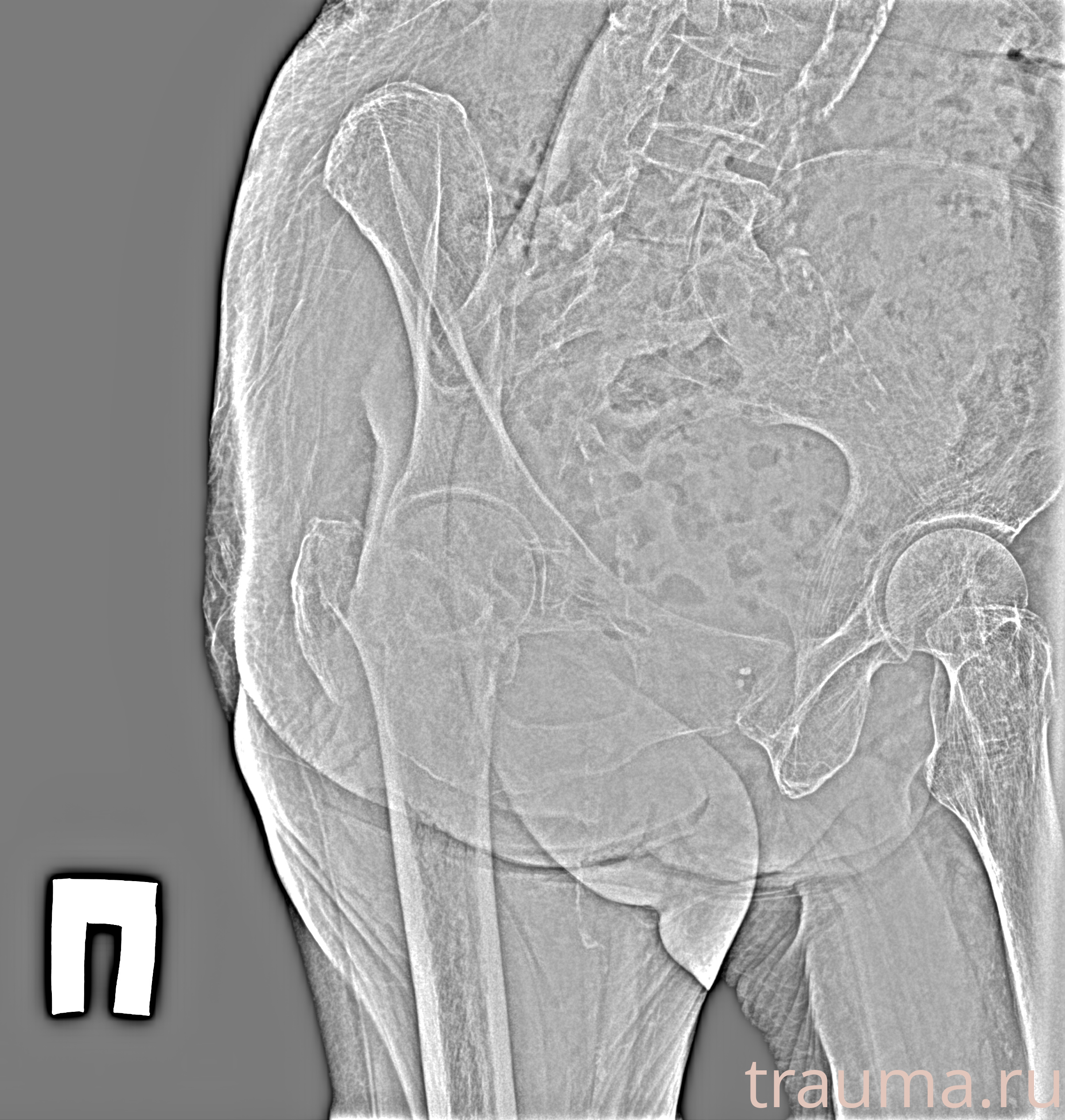 Рентген на дому: по вашему адресу приезжает врач-рентгенолог, травматолог-ортопед с мобильным рентгеновским аппаратом, проводит диагностику травмы или заболевания, делает необходимые рентгенограммы, дает рекомендации по дальнейшему лечению. Получить качественные снимки в домашних условиях возможно благодаря уникальной методике, разработанной МосРентген Центром для института  Склифосовского