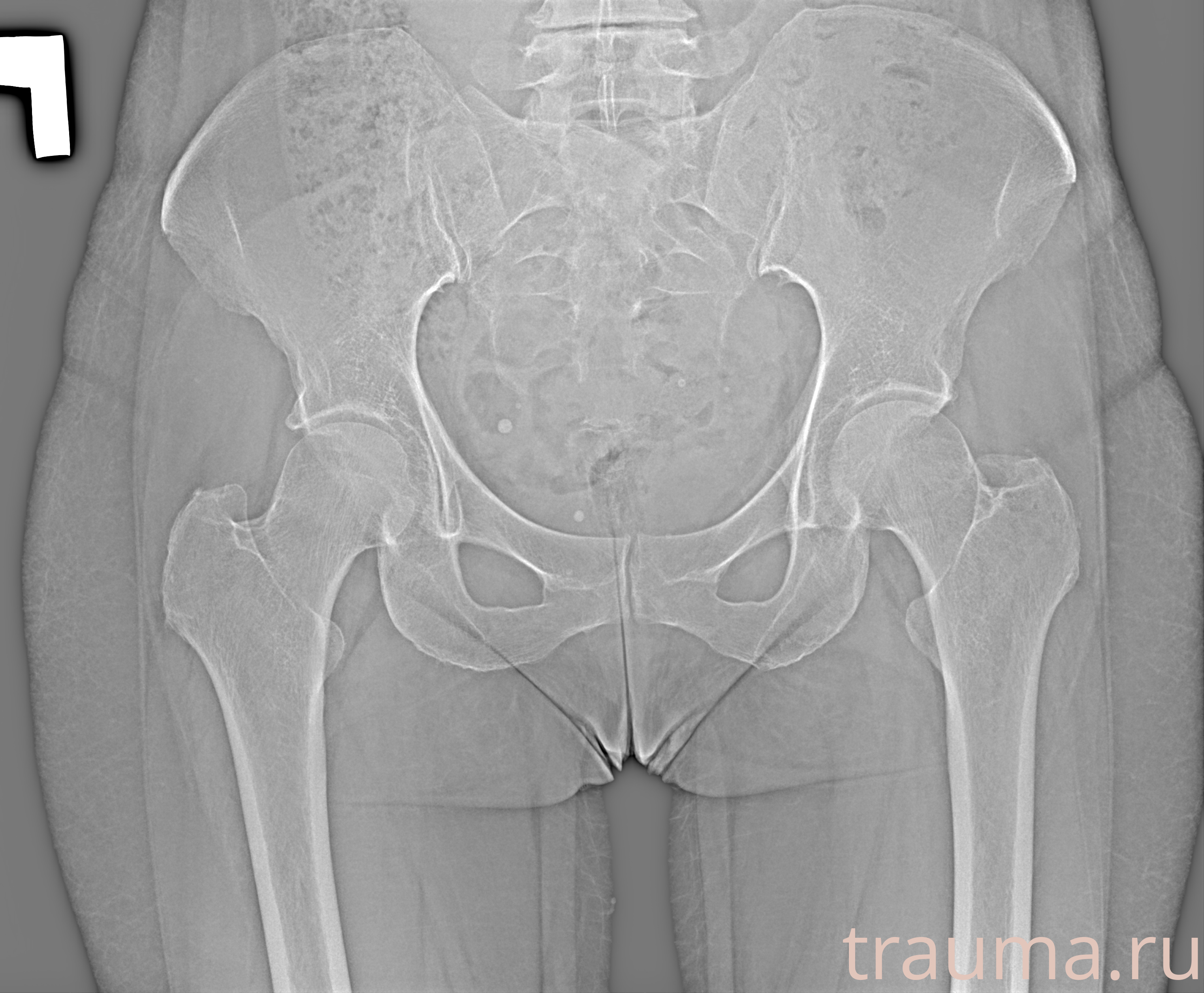 Рентген на дому: по вашему адресу приезжает врач-рентгенолог, травматолог-ортопед с мобильным рентгеновским аппаратом, проводит диагностику травмы или заболевания, делает необходимые рентгенограммы, дает рекомендации по дальнейшему лечению. Получить качественные снимки в домашних условиях возможно благодаря уникальной методике, разработанной МосРентген Центром для института  Склифосовского