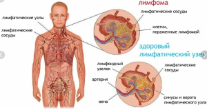 Лимфома Ходжкина
Лимфома Ходжкина