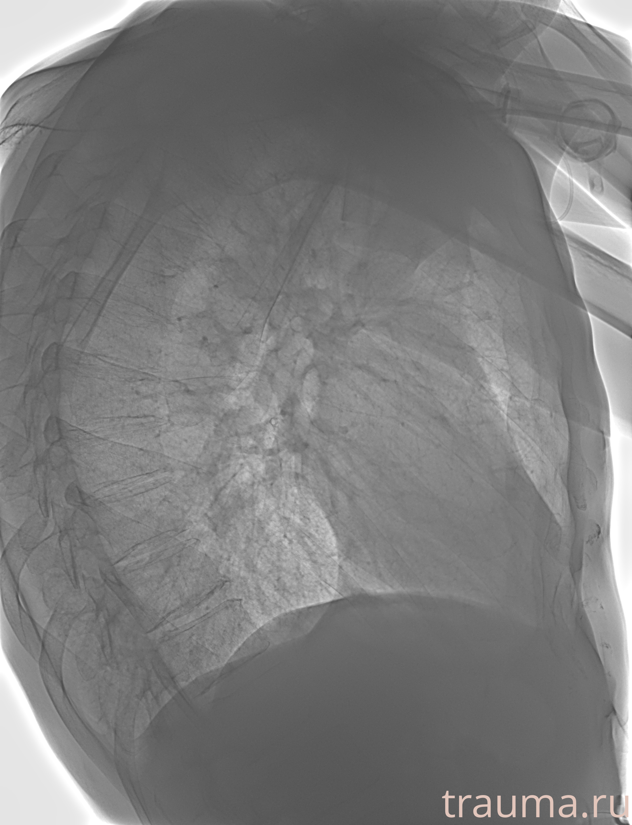 Рентген на дому: по вашему адресу приезжает врач-рентгенолог, травматолог-ортопед с мобильным рентгеновским аппаратом, проводит диагностику травмы или заболевания, делает необходимые рентгенограммы, дает рекомендации по дальнейшему лечению. Получить качественные снимки в домашних условиях возможно благодаря уникальной методике, разработанной МосРентген Центром для института  Склифосовского