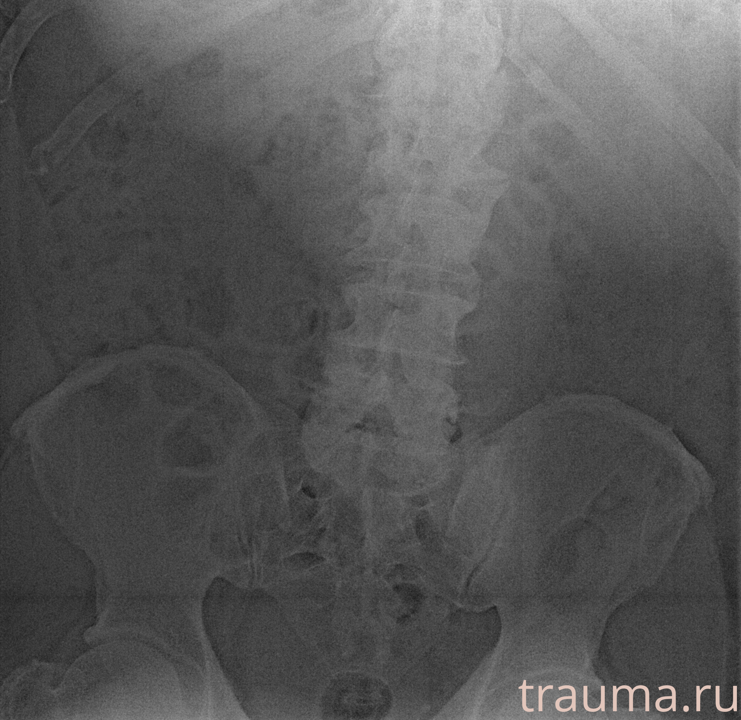 Рентген на дому: по вашему адресу приезжает врач-рентгенолог, травматолог-ортопед с мобильным рентгеновским аппаратом, проводит диагностику травмы или заболевания, делает необходимые рентгенограммы, дает рекомендации по дальнейшему лечению. Получить качественные снимки в домашних условиях возможно благодаря уникальной методике, разработанной МосРентген Центром для института  Склифосовского