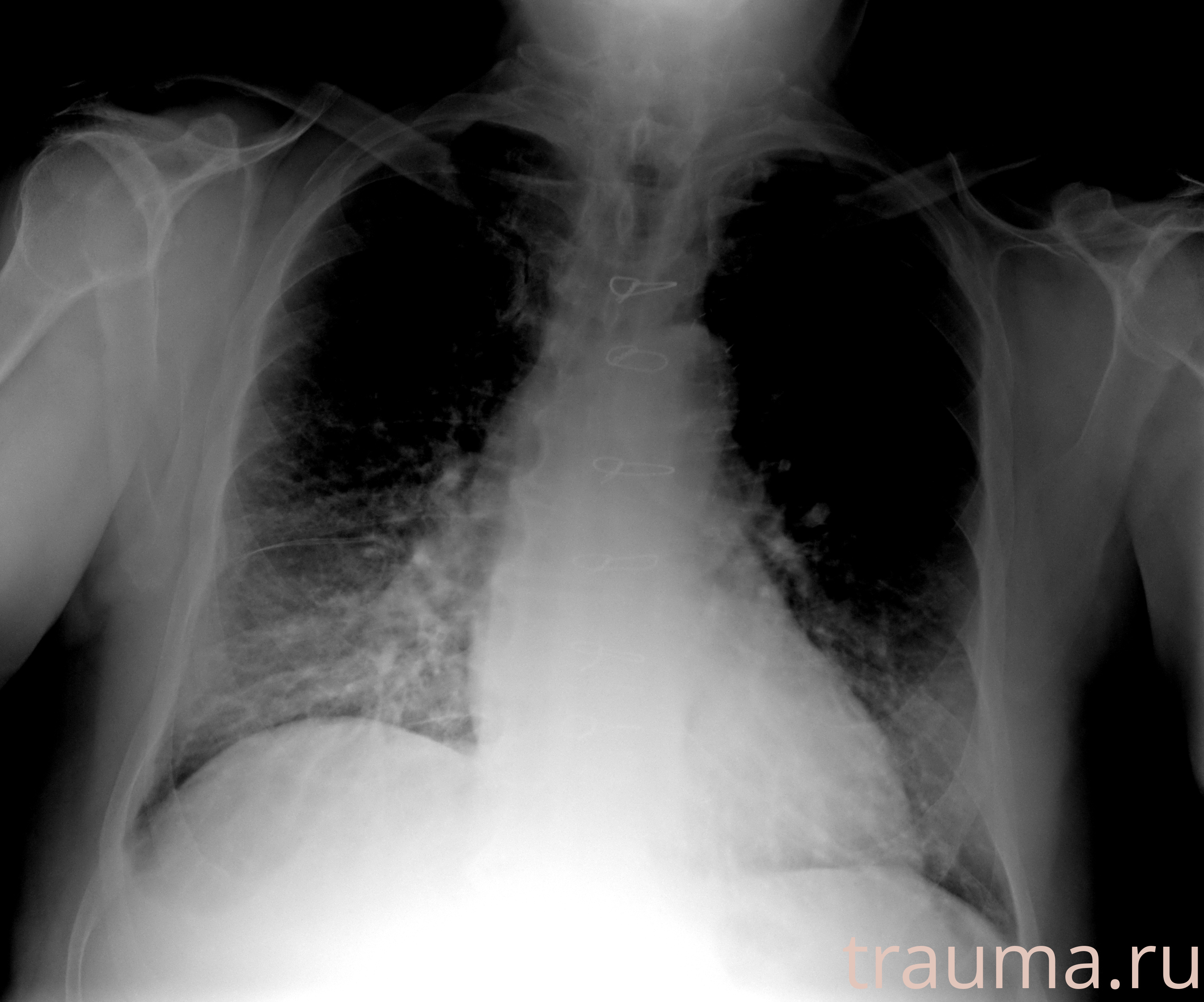Рентген на дому: по вашему адресу приезжает врач-рентгенолог, травматолог-ортопед с мобильным рентгеновским аппаратом, проводит диагностику травмы или заболевания, делает необходимые рентгенограммы, дает рекомендации по дальнейшему лечению. Получить качественные снимки в домашних условиях возможно благодаря уникальной методике, разработанной МосРентген Центром для института  Склифосовского