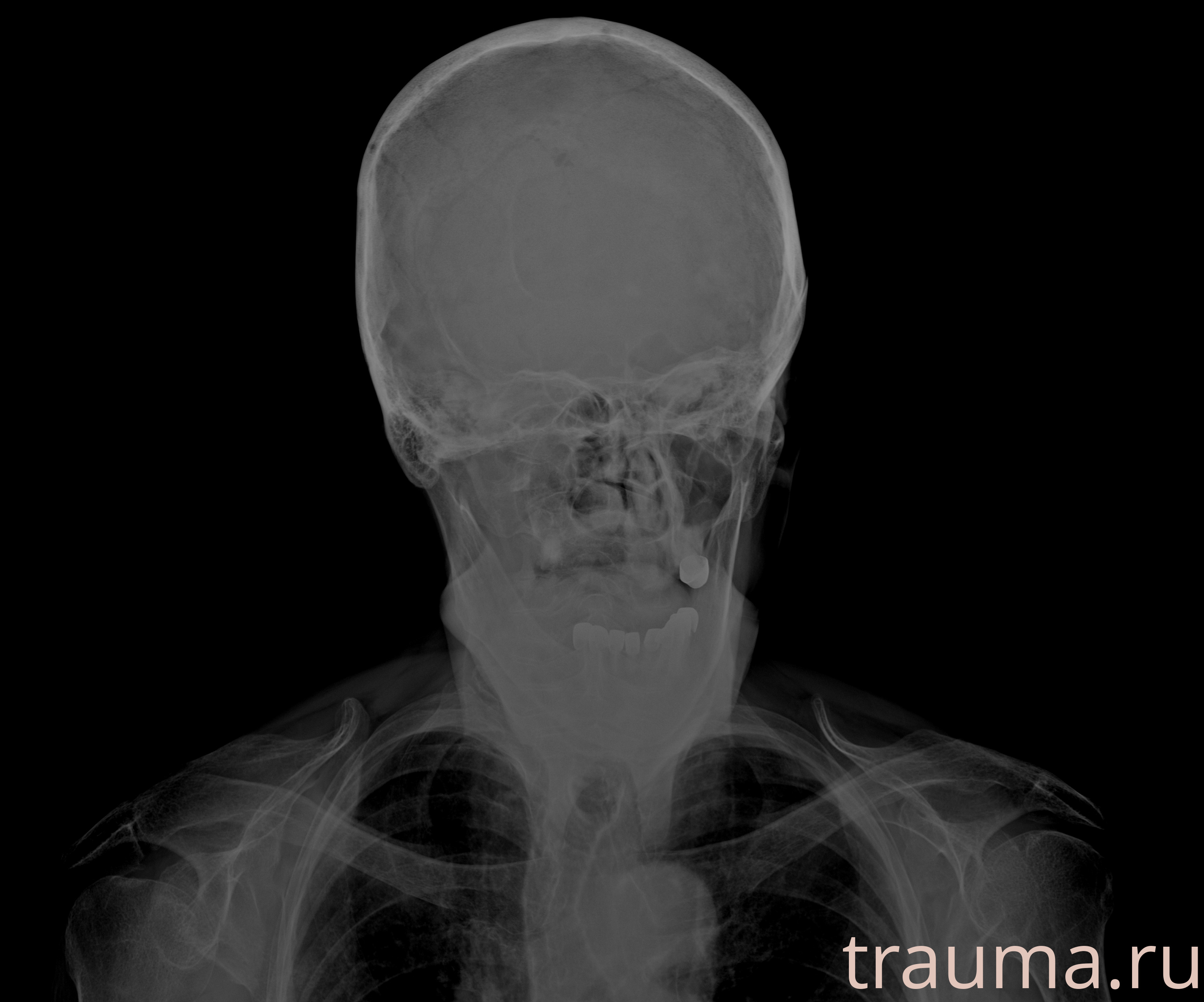 Рентген на дому: по вашему адресу приезжает врач-рентгенолог, травматолог-ортопед с мобильным рентгеновским аппаратом, проводит диагностику травмы или заболевания, делает необходимые рентгенограммы, дает рекомендации по дальнейшему лечению. Получить качественные снимки в домашних условиях возможно благодаря уникальной методике, разработанной МосРентген Центром для института  Склифосовского