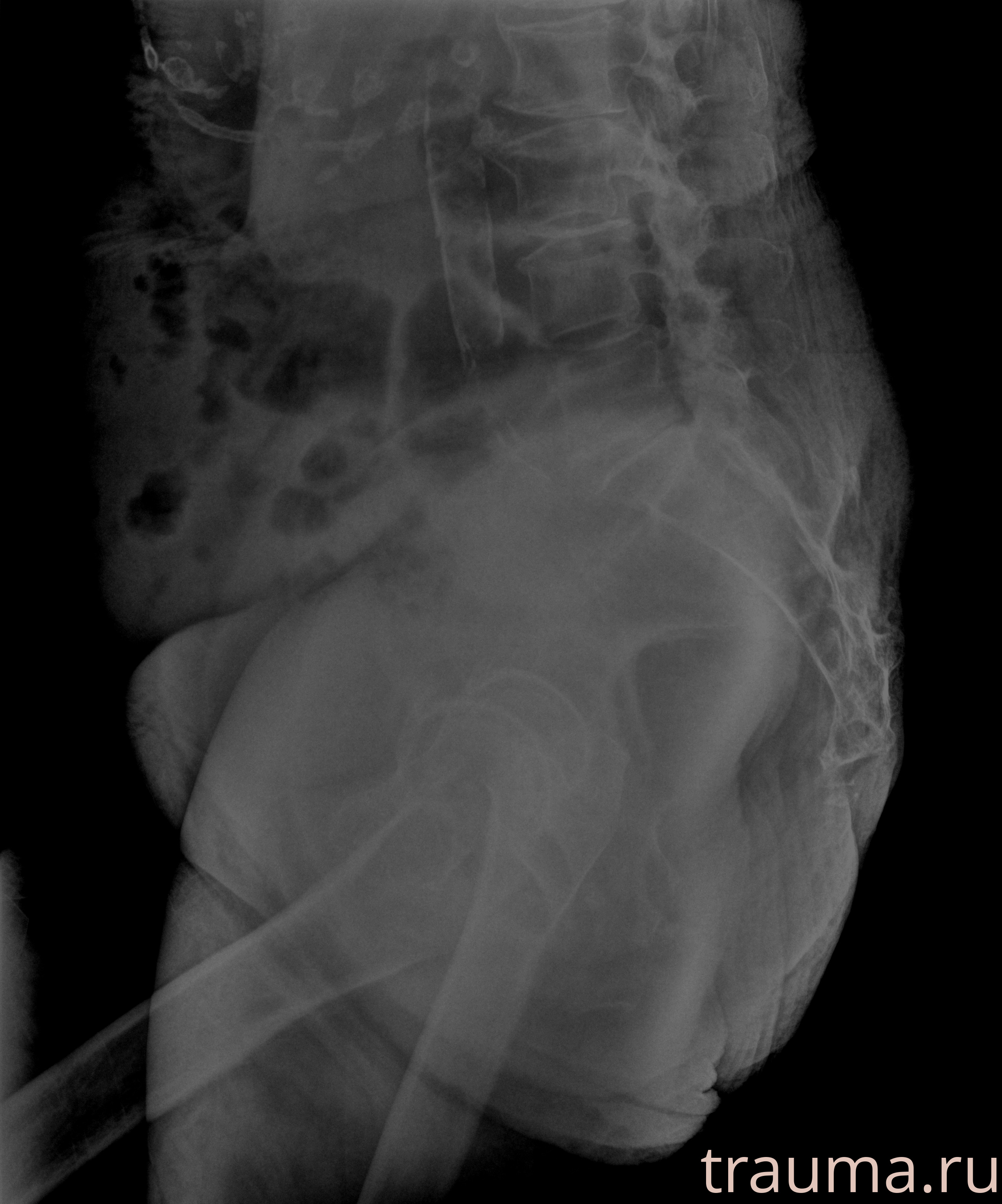 Рентген на дому: по вашему адресу приезжает врач-рентгенолог, травматолог-ортопед с мобильным рентгеновским аппаратом, проводит диагностику травмы или заболевания, делает необходимые рентгенограммы, дает рекомендации по дальнейшему лечению. Получить качественные снимки в домашних условиях возможно благодаря уникальной методике, разработанной МосРентген Центром для института  Склифосовского