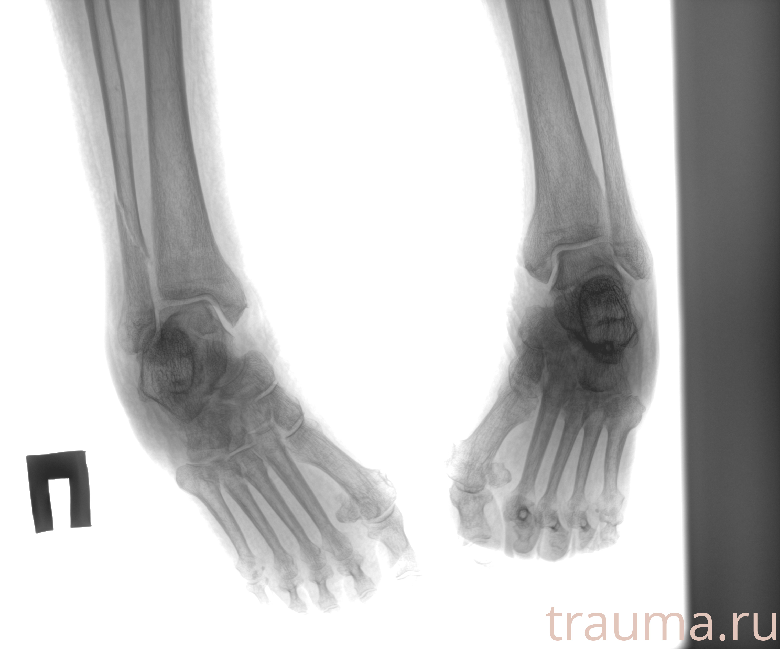 Рентген на дому: по вашему адресу приезжает врач-рентгенолог, травматолог-ортопед с мобильным рентгеновским аппаратом, проводит диагностику травмы или заболевания, делает необходимые рентгенограммы, дает рекомендации по дальнейшему лечению. Получить качественные снимки в домашних условиях возможно благодаря уникальной методике, разработанной МосРентген Центром для института  Склифосовского