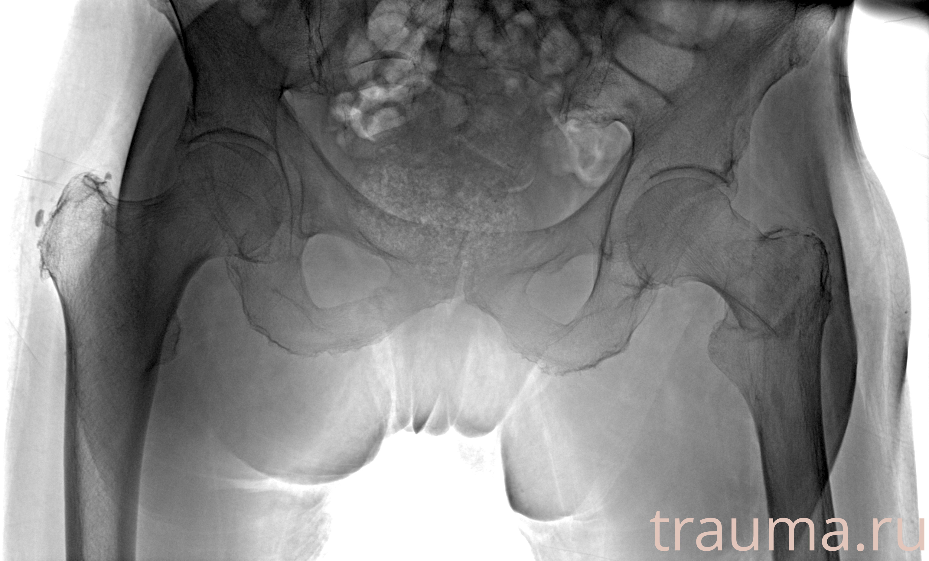 Рентген на дому: по вашему адресу приезжает врач-рентгенолог, травматолог-ортопед с мобильным рентгеновским аппаратом, проводит диагностику травмы или заболевания, делает необходимые рентгенограммы, дает рекомендации по дальнейшему лечению. Получить качественные снимки в домашних условиях возможно благодаря уникальной методике, разработанной МосРентген Центром для института  Склифосовского