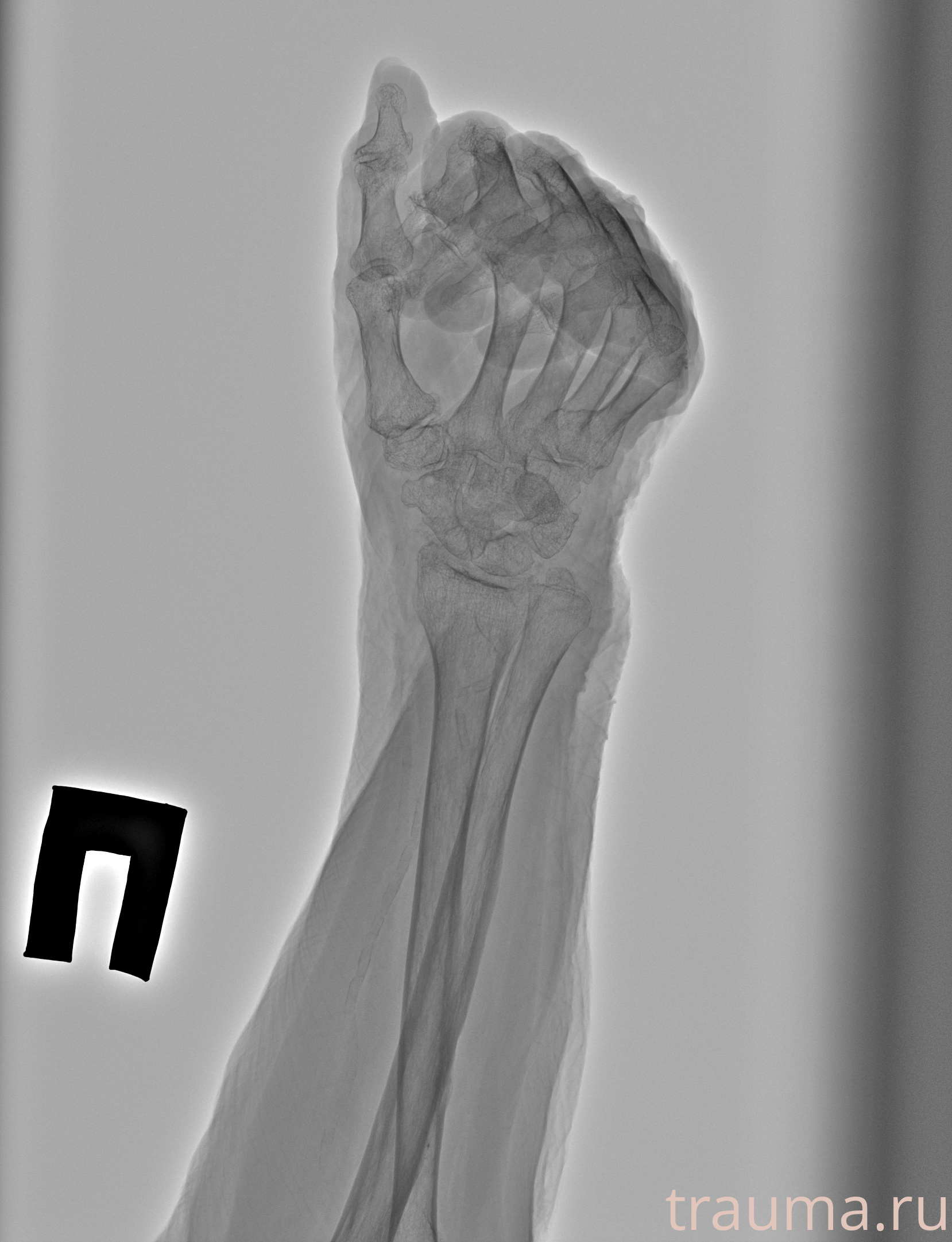 Рентген на дому: по вашему адресу приезжает врач-рентгенолог, травматолог-ортопед с мобильным рентгеновским аппаратом, проводит диагностику травмы или заболевания, делает необходимые рентгенограммы, дает рекомендации по дальнейшему лечению. Получить качественные снимки в домашних условиях возможно благодаря уникальной методике, разработанной МосРентген Центром для института  Склифосовского