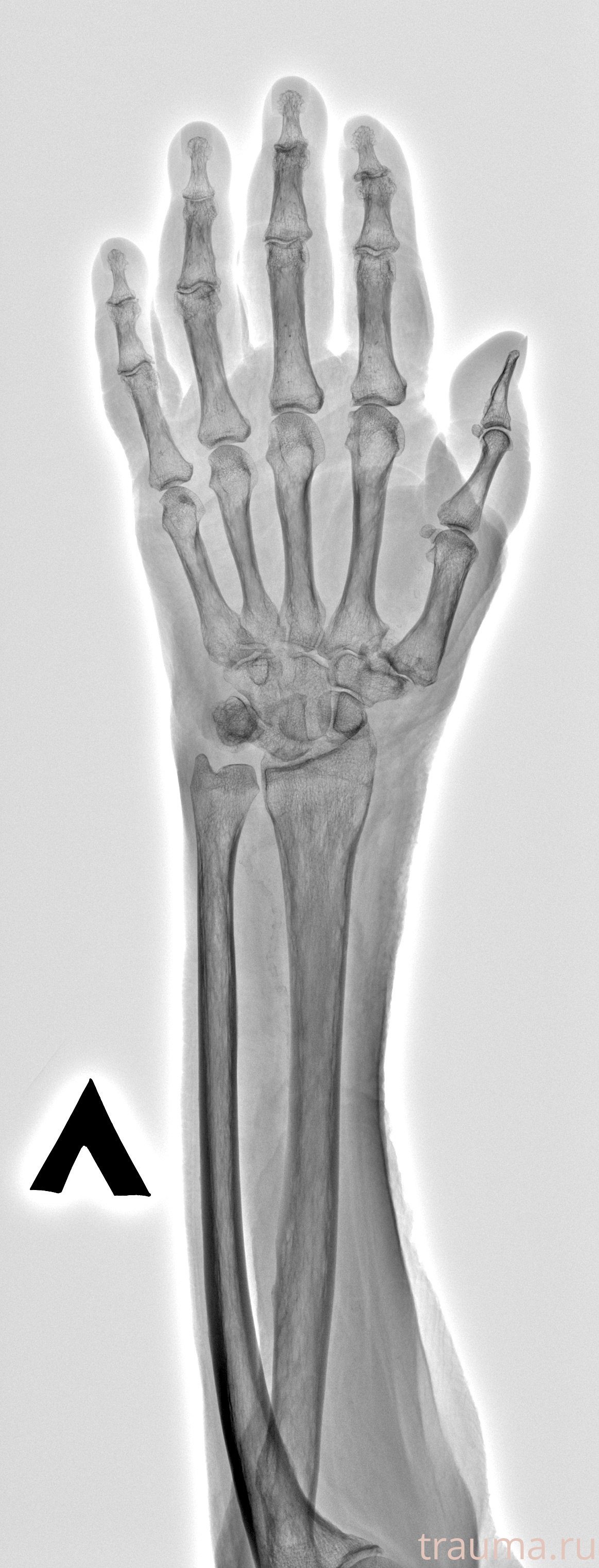 Рентген на дому: по вашему адресу приезжает врач-рентгенолог, травматолог-ортопед с мобильным рентгеновским аппаратом, проводит диагностику травмы или заболевания, делает необходимые рентгенограммы, дает рекомендации по дальнейшему лечению. Получить качественные снимки в домашних условиях возможно благодаря уникальной методике, разработанной МосРентген Центром для института  Склифосовского