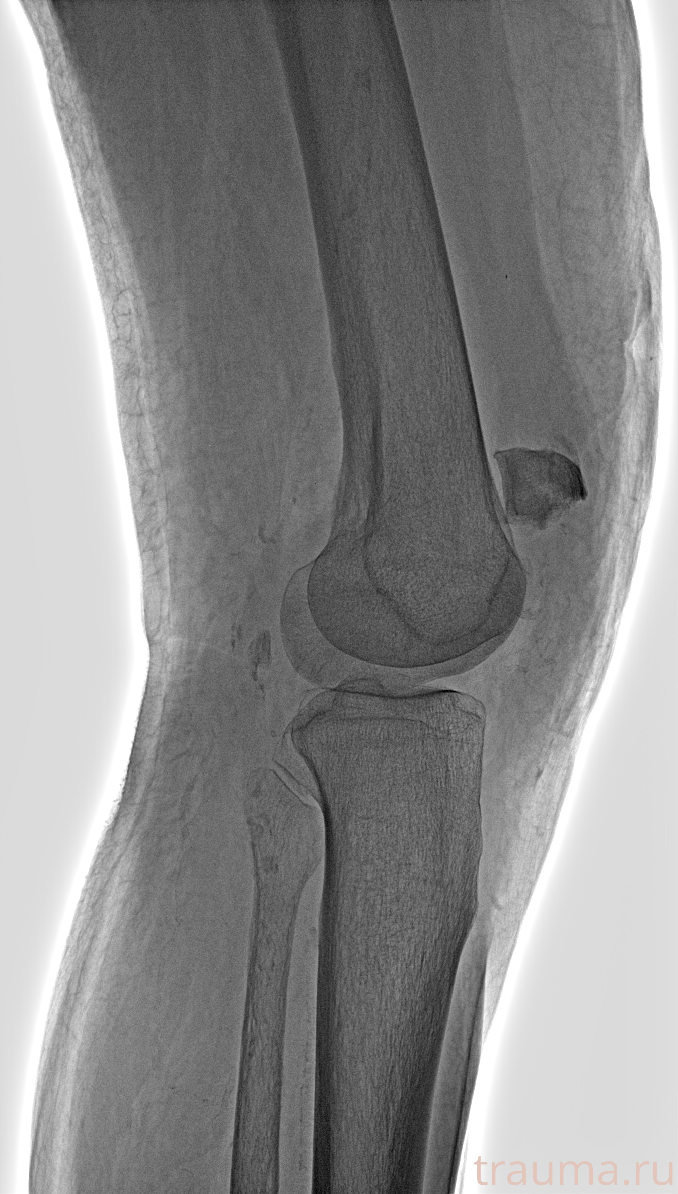Рентген на дому: по вашему адресу приезжает врач-рентгенолог, травматолог-ортопед с мобильным рентгеновским аппаратом, проводит диагностику травмы или заболевания, делает необходимые рентгенограммы, дает рекомендации по дальнейшему лечению. Получить качественные снимки в домашних условиях возможно благодаря уникальной методике, разработанной МосРентген Центром для института  Склифосовского