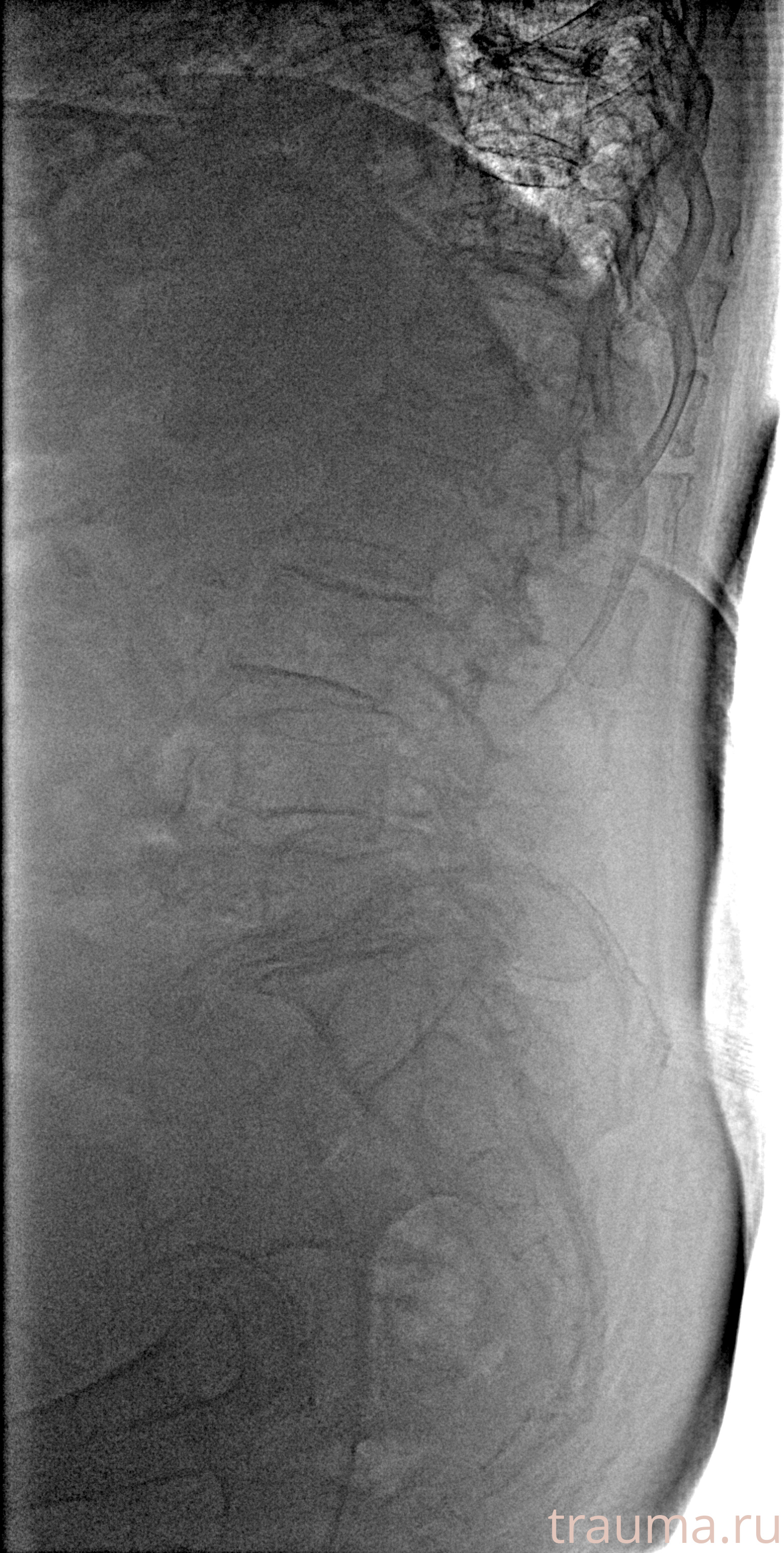 Рентген на дому: по вашему адресу приезжает врач-рентгенолог, травматолог-ортопед с мобильным рентгеновским аппаратом, проводит диагностику травмы или заболевания, делает необходимые рентгенограммы, дает рекомендации по дальнейшему лечению. Получить качественные снимки в домашних условиях возможно благодаря уникальной методике, разработанной МосРентген Центром для института  Склифосовского