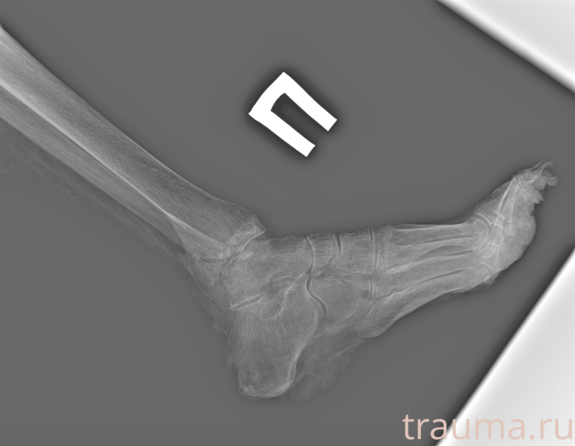 Рентген на дому: по вашему адресу приезжает врач-рентгенолог, травматолог-ортопед с мобильным рентгеновским аппаратом, проводит диагностику травмы или заболевания, делает необходимые рентгенограммы, дает рекомендации по дальнейшему лечению. Получить качественные снимки в домашних условиях возможно благодаря уникальной методике, разработанной МосРентген Центром для института  Склифосовского