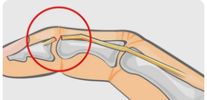 Ретроспективный анализ отдаленных результатов лечения подкожных разрывов сухожилий разгибателей пальцев кисти с их молоткообразной деформацией