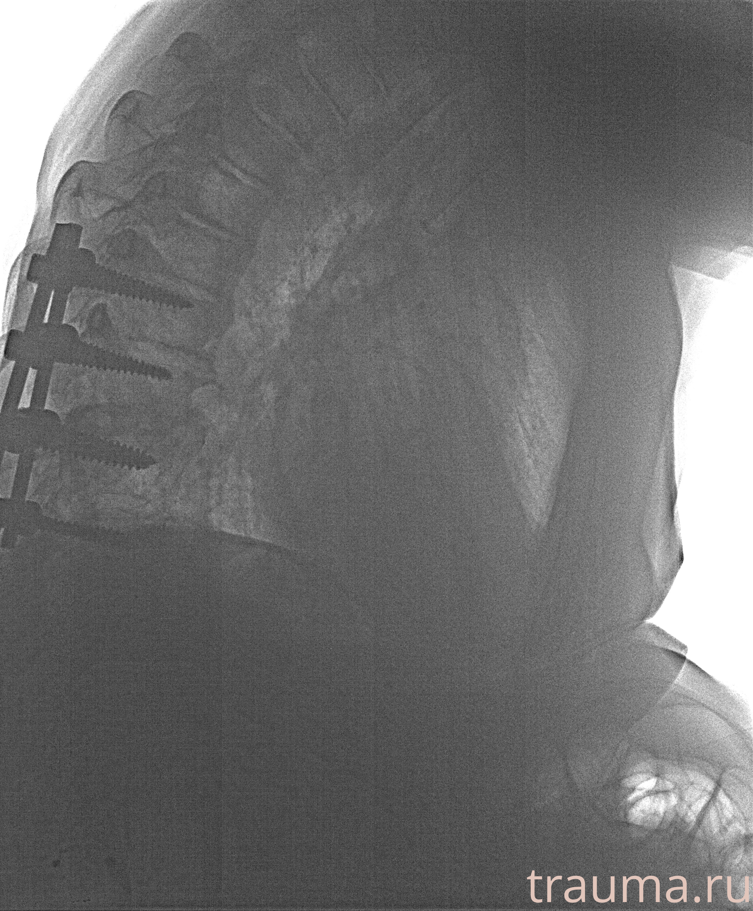 Рентген на дому: по вашему адресу приезжает врач-рентгенолог, травматолог-ортопед с мобильным рентгеновским аппаратом, проводит диагностику травмы или заболевания, делает необходимые рентгенограммы, дает рекомендации по дальнейшему лечению. Получить качественные снимки в домашних условиях возможно благодаря уникальной методике, разработанной МосРентген Центром для института  Склифосовского