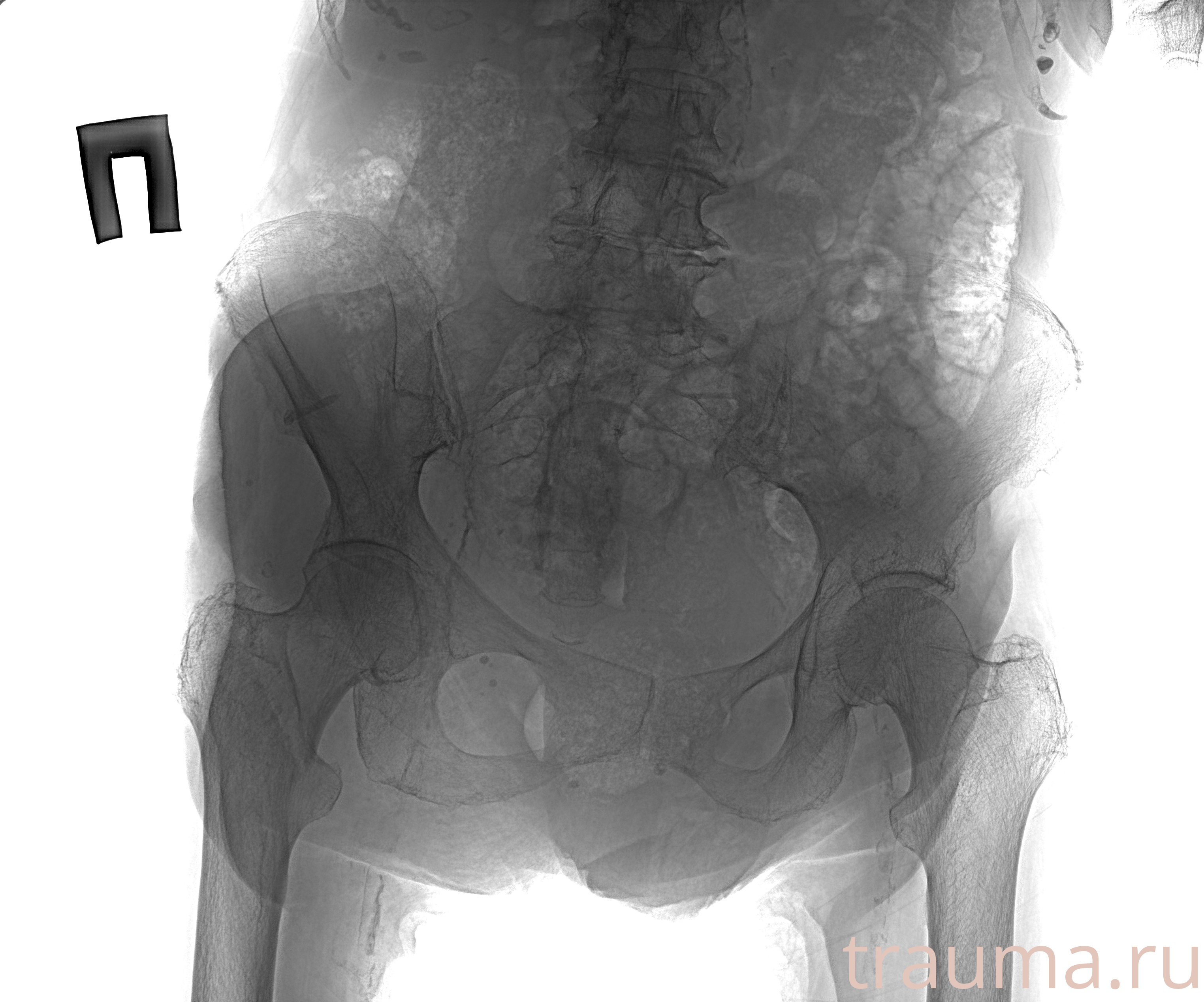 Рентген на дому: по вашему адресу приезжает врач-рентгенолог, травматолог-ортопед с мобильным рентгеновским аппаратом, проводит диагностику травмы или заболевания, делает необходимые рентгенограммы, дает рекомендации по дальнейшему лечению. Получить качественные снимки в домашних условиях возможно благодаря уникальной методике, разработанной МосРентген Центром для института  Склифосовского