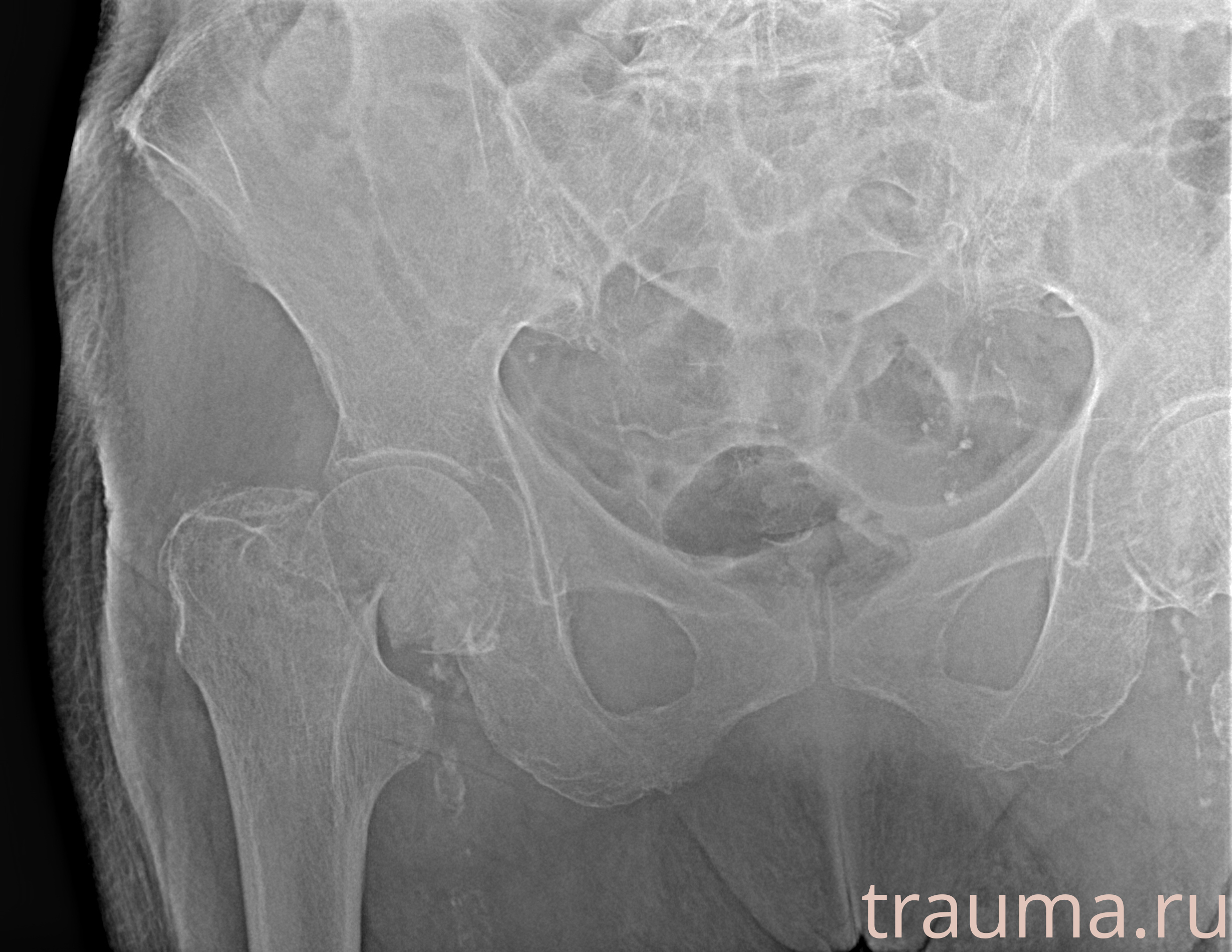 Рентген на дому: по вашему адресу приезжает врач-рентгенолог, травматолог-ортопед с мобильным рентгеновским аппаратом, проводит диагностику травмы или заболевания, делает необходимые рентгенограммы, дает рекомендации по дальнейшему лечению. Получить качественные снимки в домашних условиях возможно благодаря уникальной методике, разработанной МосРентген Центром для института  Склифосовского