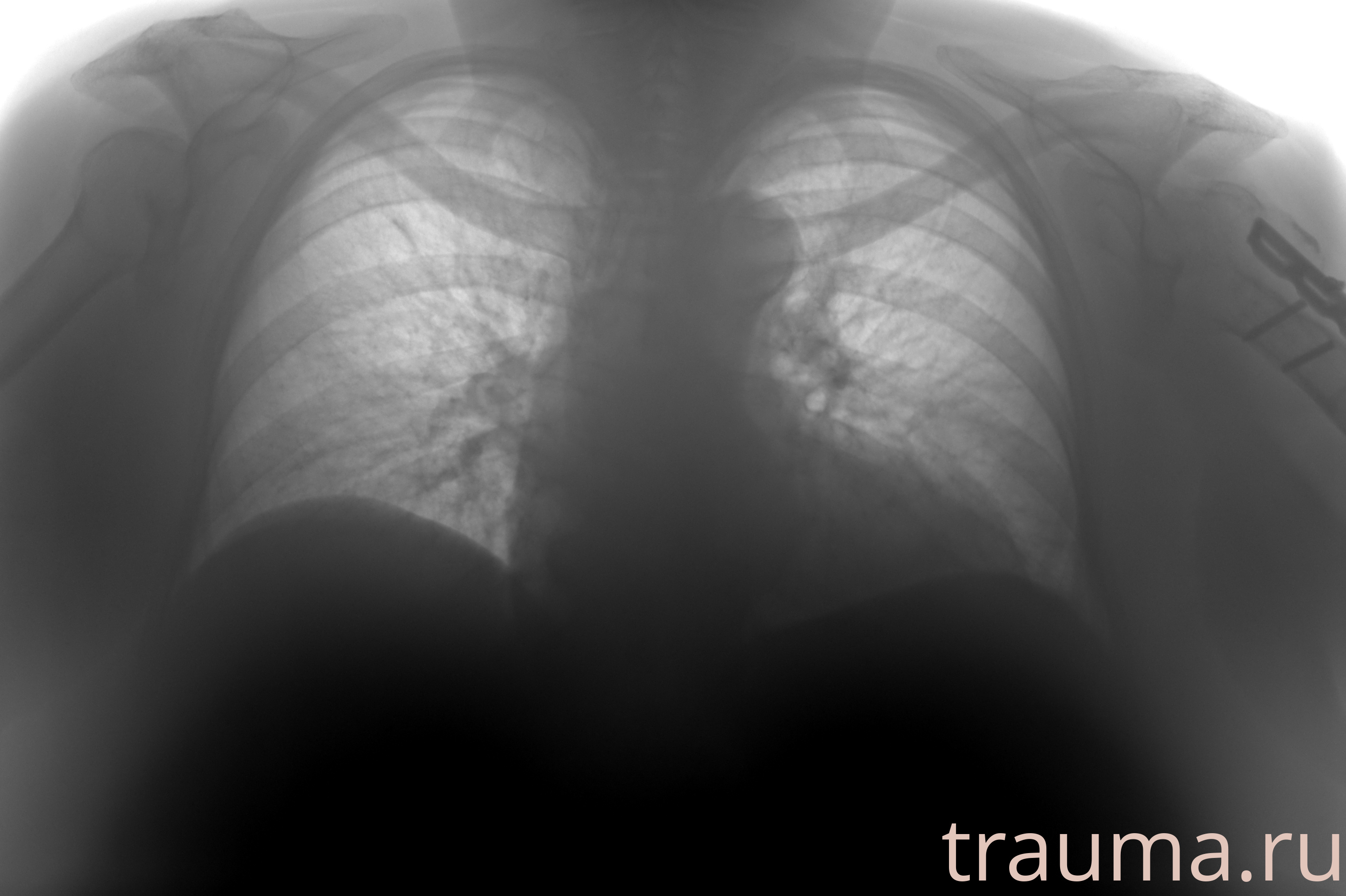 Рентген на дому: по вашему адресу приезжает врач-рентгенолог, травматолог-ортопед с мобильным рентгеновским аппаратом, проводит диагностику травмы или заболевания, делает необходимые рентгенограммы, дает рекомендации по дальнейшему лечению. Получить качественные снимки в домашних условиях возможно благодаря уникальной методике, разработанной МосРентген Центром для института  Склифосовского