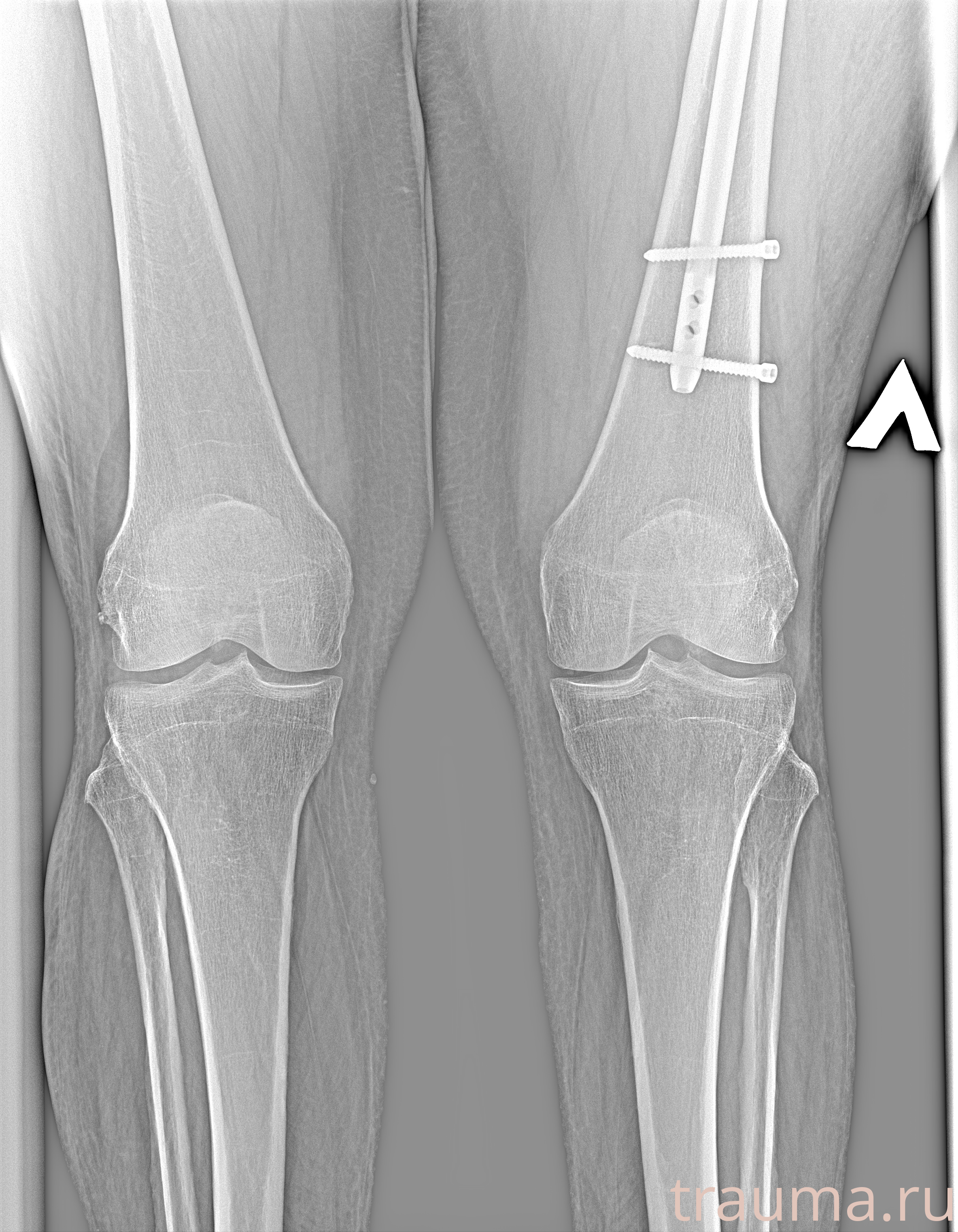 Рентген на дому: по вашему адресу приезжает врач-рентгенолог, травматолог-ортопед с мобильным рентгеновским аппаратом, проводит диагностику травмы или заболевания, делает необходимые рентгенограммы, дает рекомендации по дальнейшему лечению. Получить качественные снимки в домашних условиях возможно благодаря уникальной методике, разработанной МосРентген Центром для института  Склифосовского