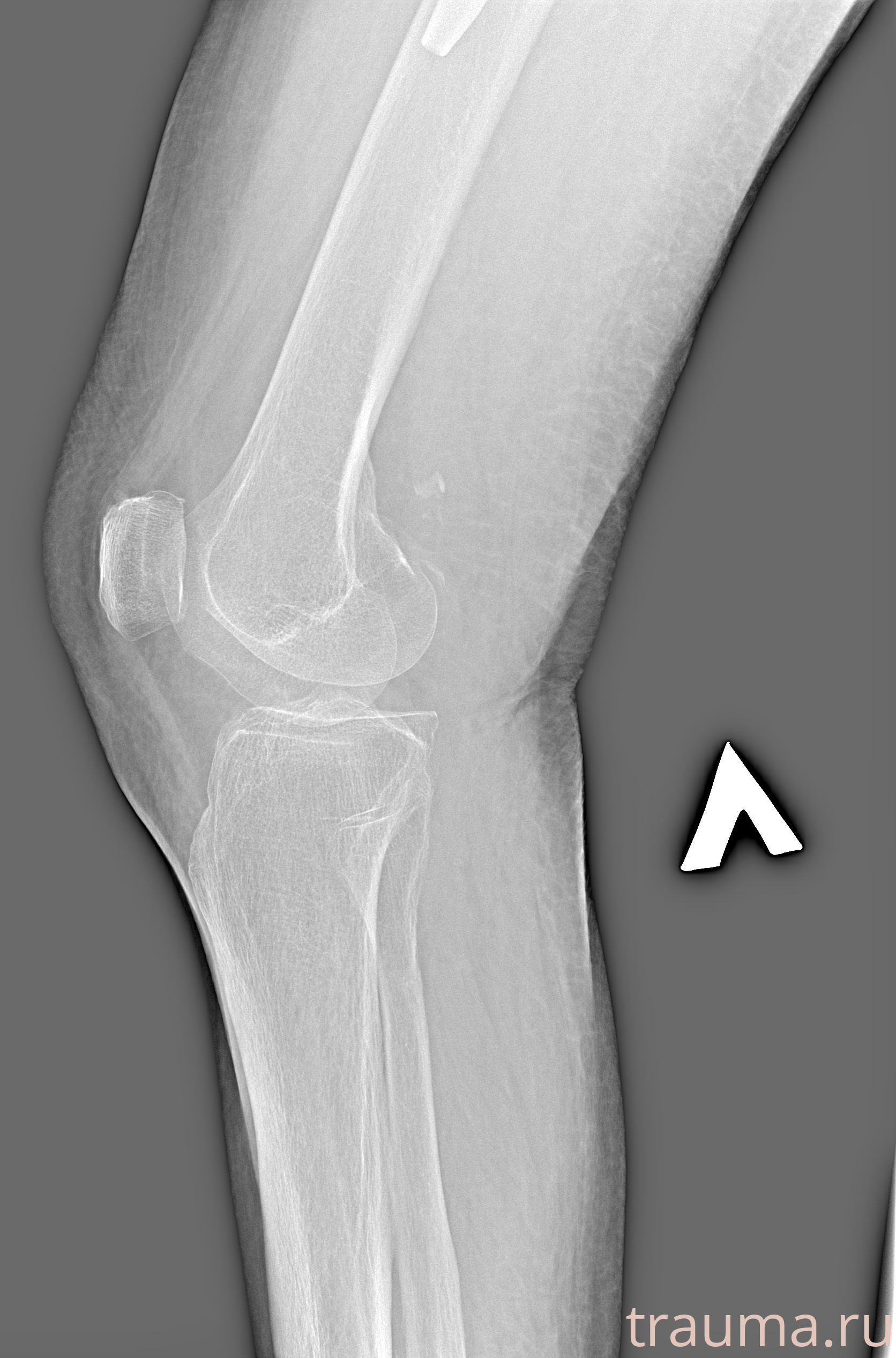 Рентген на дому: по вашему адресу приезжает врач-рентгенолог, травматолог-ортопед с мобильным рентгеновским аппаратом, проводит диагностику травмы или заболевания, делает необходимые рентгенограммы, дает рекомендации по дальнейшему лечению. Получить качественные снимки в домашних условиях возможно благодаря уникальной методике, разработанной МосРентген Центром для института  Склифосовского