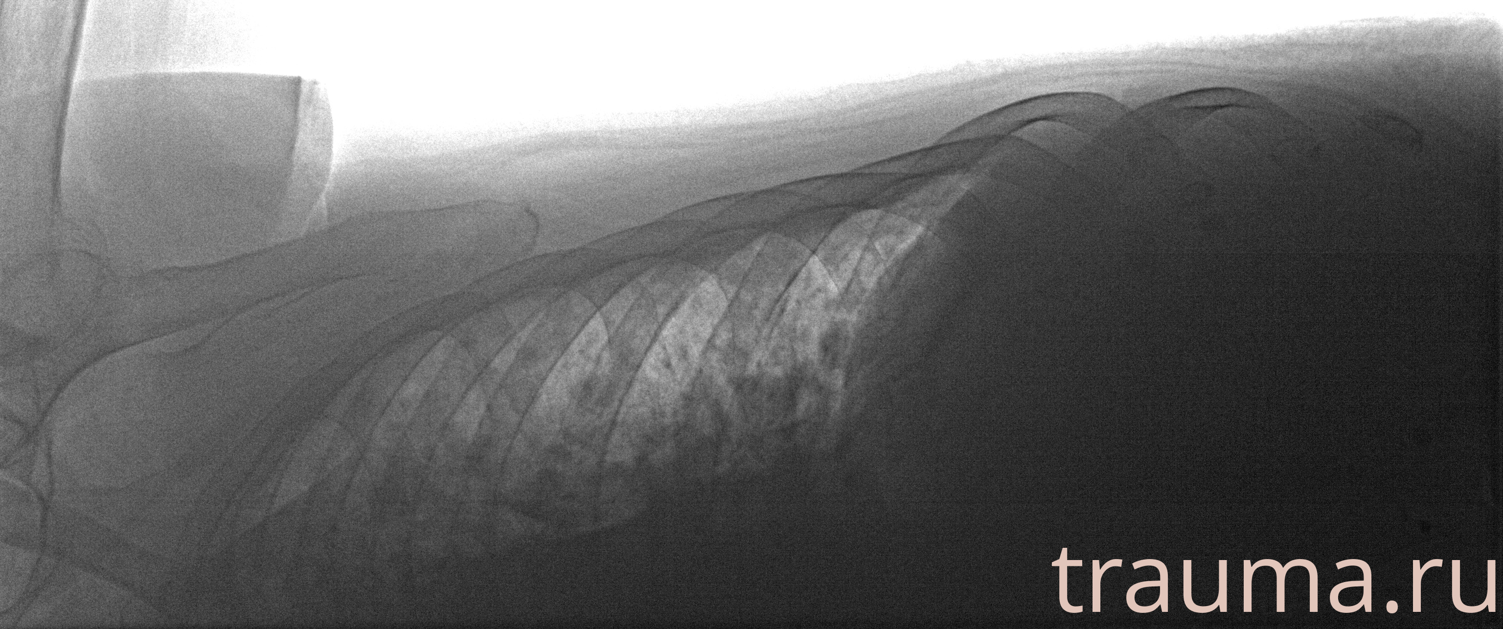 Рентген на дому: по вашему адресу приезжает врач-рентгенолог, травматолог-ортопед с мобильным рентгеновским аппаратом, проводит диагностику травмы или заболевания, делает необходимые рентгенограммы, дает рекомендации по дальнейшему лечению. Получить качественные снимки в домашних условиях возможно благодаря уникальной методике, разработанной МосРентген Центром для института  Склифосовского
