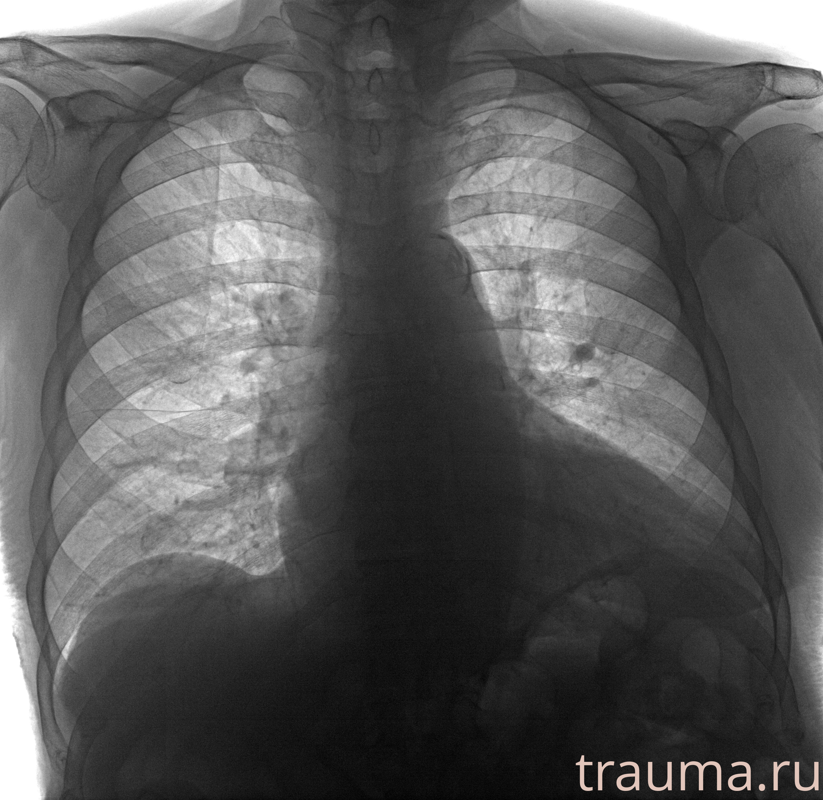 Рентген на дому: по вашему адресу приезжает врач-рентгенолог, травматолог-ортопед с мобильным рентгеновским аппаратом, проводит диагностику травмы или заболевания, делает необходимые рентгенограммы, дает рекомендации по дальнейшему лечению. Получить качественные снимки в домашних условиях возможно благодаря уникальной методике, разработанной МосРентген Центром для института  Склифосовского