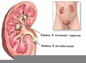 Мочекаменная болезнь Мочекаменная болезнь