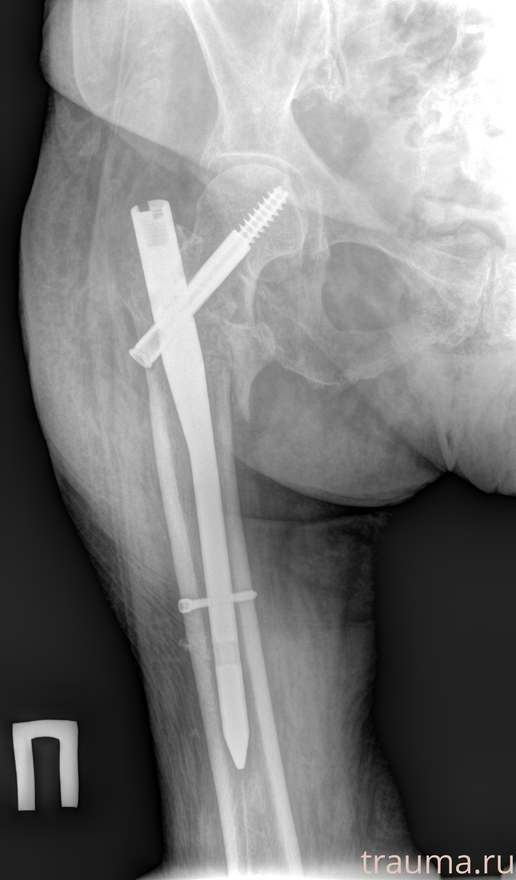 Рентген на дому: по вашему адресу приезжает врач-рентгенолог, травматолог-ортопед с мобильным рентгеновским аппаратом, проводит диагностику травмы или заболевания, делает необходимые рентгенограммы, дает рекомендации по дальнейшему лечению. Получить качественные снимки в домашних условиях возможно благодаря уникальной методике, разработанной МосРентген Центром для института  Склифосовского