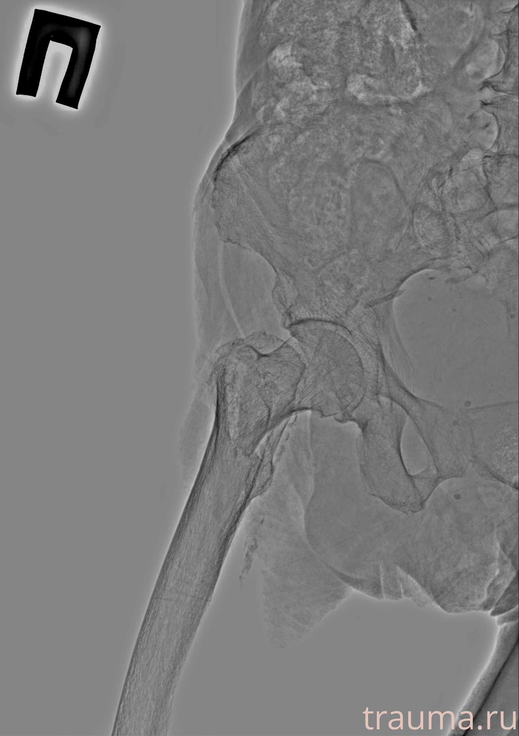 Рентген на дому: по вашему адресу приезжает врач-рентгенолог, травматолог-ортопед с мобильным рентгеновским аппаратом, проводит диагностику травмы или заболевания, делает необходимые рентгенограммы, дает рекомендации по дальнейшему лечению. Получить качественные снимки в домашних условиях возможно благодаря уникальной методике, разработанной МосРентген Центром для института  Склифосовского