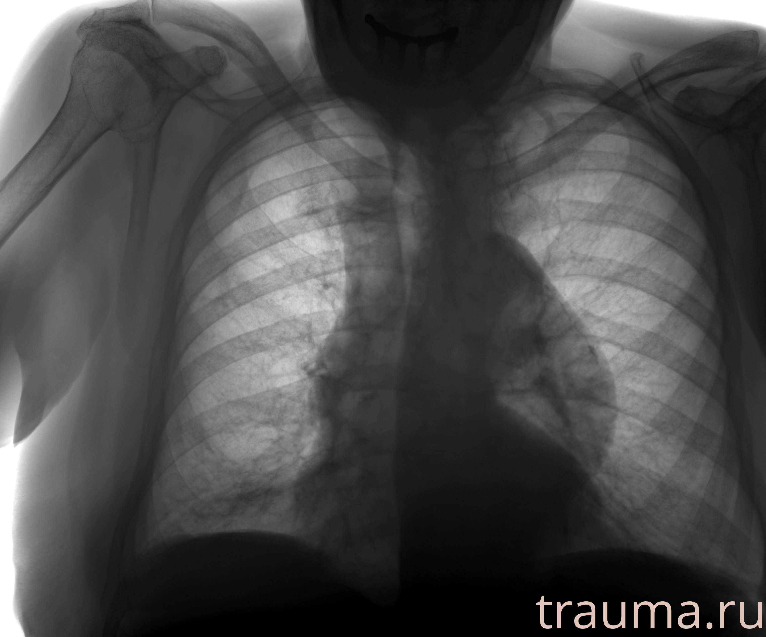 Рентген на дому: по вашему адресу приезжает врач-рентгенолог, травматолог-ортопед с мобильным рентгеновским аппаратом, проводит диагностику травмы или заболевания, делает необходимые рентгенограммы, дает рекомендации по дальнейшему лечению. Получить качественные снимки в домашних условиях возможно благодаря уникальной методике, разработанной МосРентген Центром для института  Склифосовского