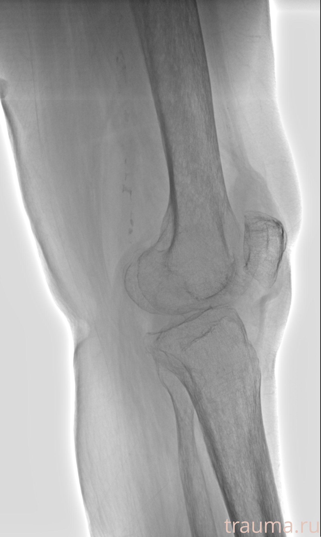Рентген на дому: по вашему адресу приезжает врач-рентгенолог, травматолог-ортопед с мобильным рентгеновским аппаратом, проводит диагностику травмы или заболевания, делает необходимые рентгенограммы, дает рекомендации по дальнейшему лечению. Получить качественные снимки в домашних условиях возможно благодаря уникальной методике, разработанной МосРентген Центром для института  Склифосовского
