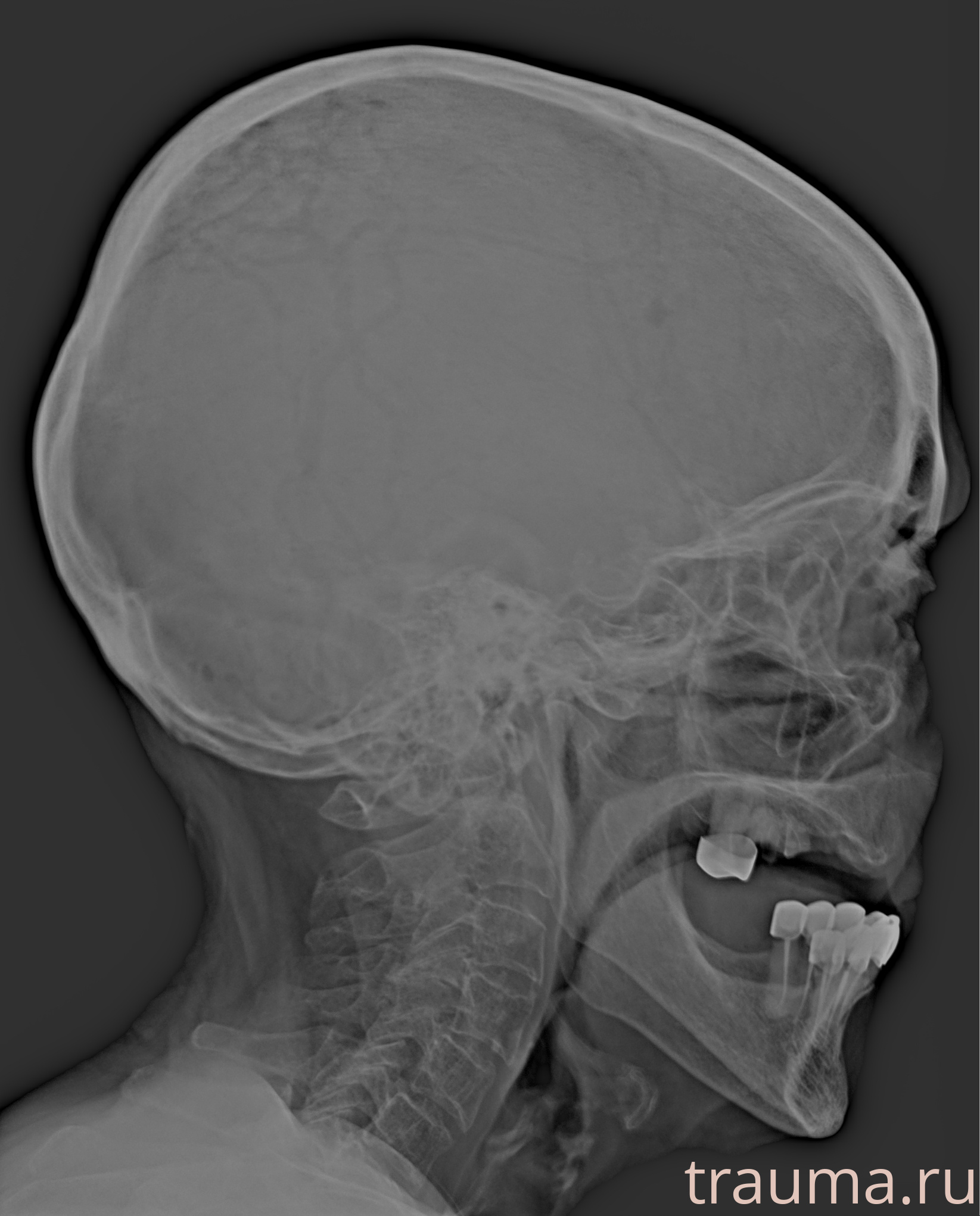Рентген на дому: по вашему адресу приезжает врач-рентгенолог, травматолог-ортопед с мобильным рентгеновским аппаратом, проводит диагностику травмы или заболевания, делает необходимые рентгенограммы, дает рекомендации по дальнейшему лечению. Получить качественные снимки в домашних условиях возможно благодаря уникальной методике, разработанной МосРентген Центром для института  Склифосовского