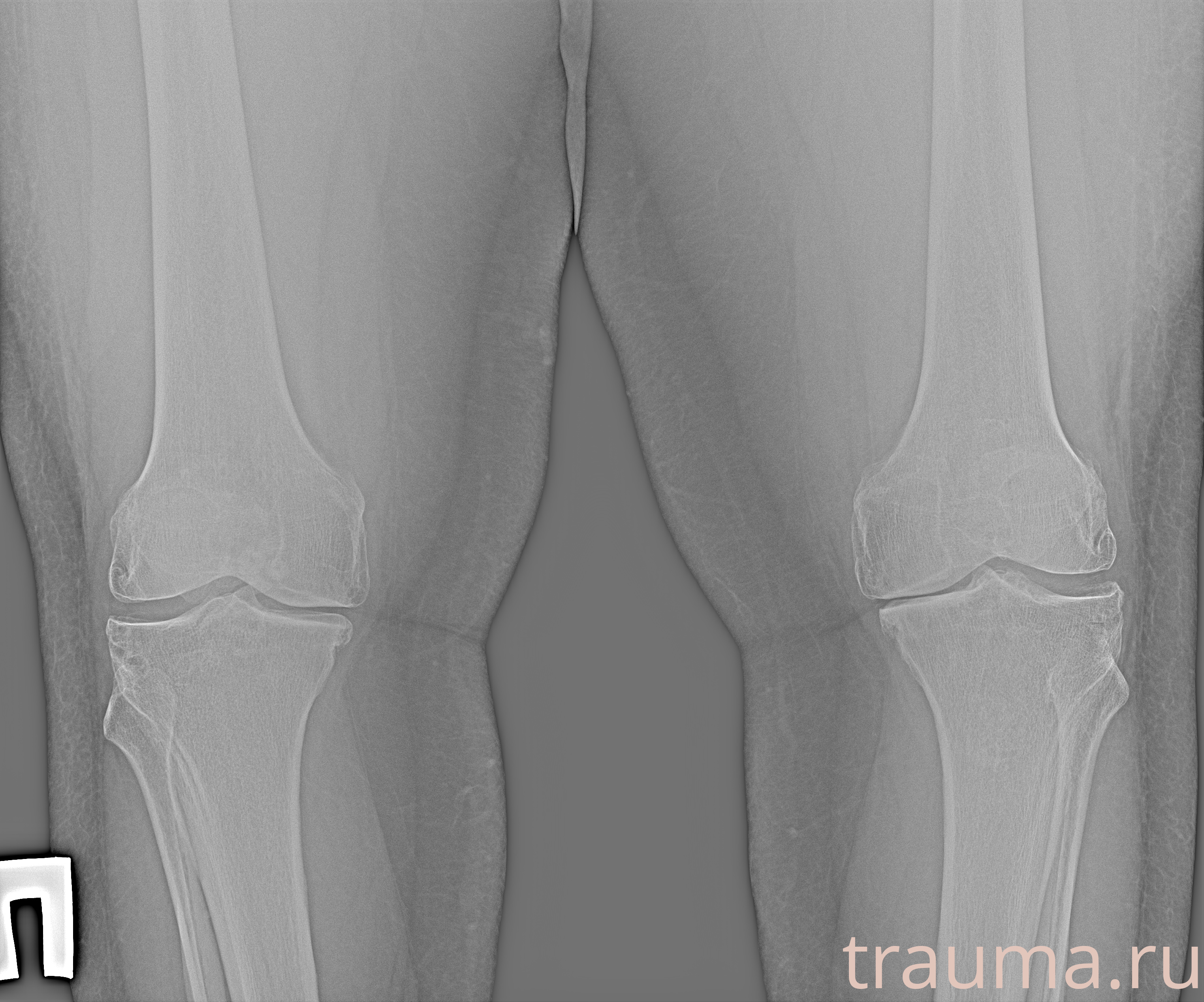 Рентген на дому: по вашему адресу приезжает врач-рентгенолог, травматолог-ортопед с мобильным рентгеновским аппаратом, проводит диагностику травмы или заболевания, делает необходимые рентгенограммы, дает рекомендации по дальнейшему лечению. Получить качественные снимки в домашних условиях возможно благодаря уникальной методике, разработанной МосРентген Центром для института  Склифосовского