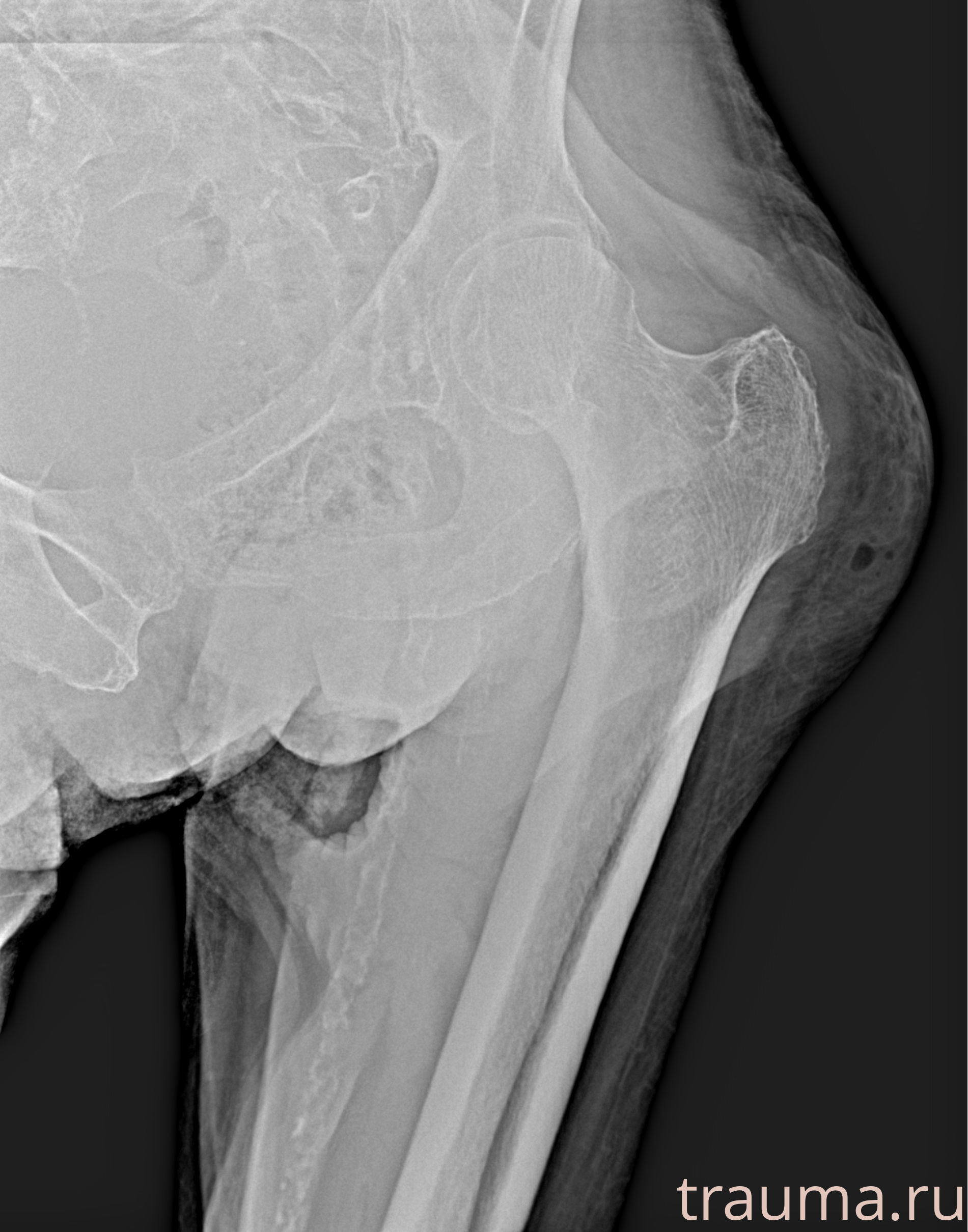 Рентген на дому: по вашему адресу приезжает врач-рентгенолог, травматолог-ортопед с мобильным рентгеновским аппаратом, проводит диагностику травмы или заболевания, делает необходимые рентгенограммы, дает рекомендации по дальнейшему лечению. Получить качественные снимки в домашних условиях возможно благодаря уникальной методике, разработанной МосРентген Центром для института  Склифосовского