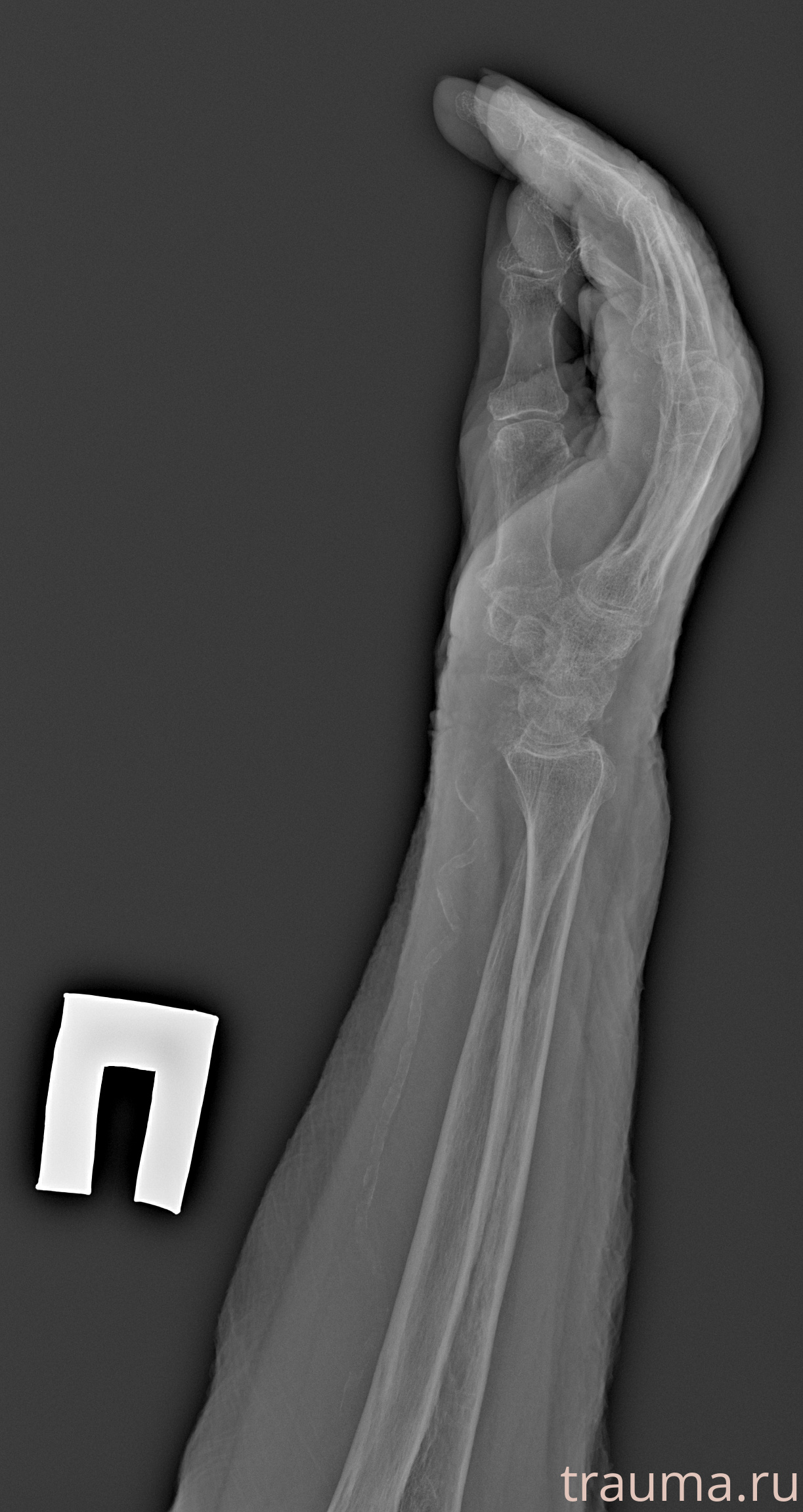 Рентген на дому: по вашему адресу приезжает врач-рентгенолог, травматолог-ортопед с мобильным рентгеновским аппаратом, проводит диагностику травмы или заболевания, делает необходимые рентгенограммы, дает рекомендации по дальнейшему лечению. Получить качественные снимки в домашних условиях возможно благодаря уникальной методике, разработанной МосРентген Центром для института  Склифосовского