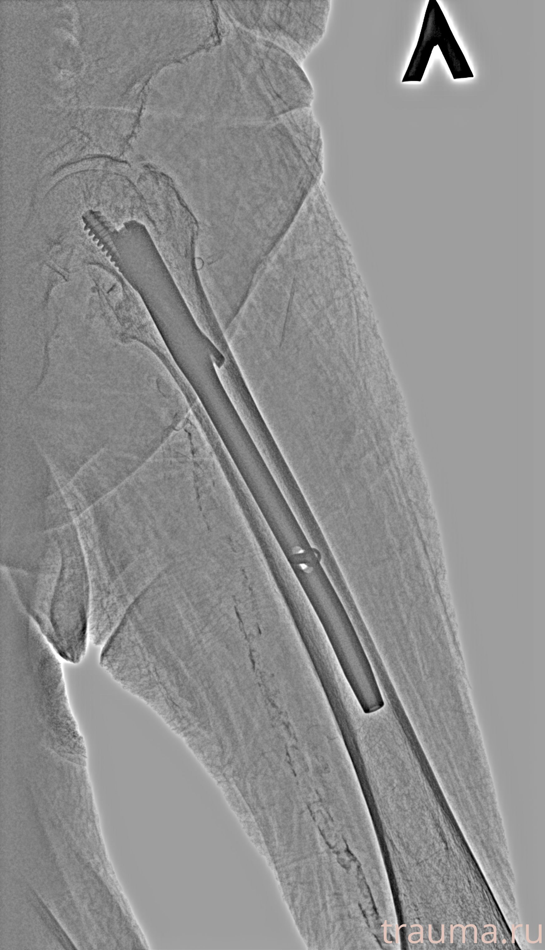 Рентген на дому: по вашему адресу приезжает врач-рентгенолог, травматолог-ортопед с мобильным рентгеновским аппаратом, проводит диагностику травмы или заболевания, делает необходимые рентгенограммы, дает рекомендации по дальнейшему лечению. Получить качественные снимки в домашних условиях возможно благодаря уникальной методике, разработанной МосРентген Центром для института  Склифосовского