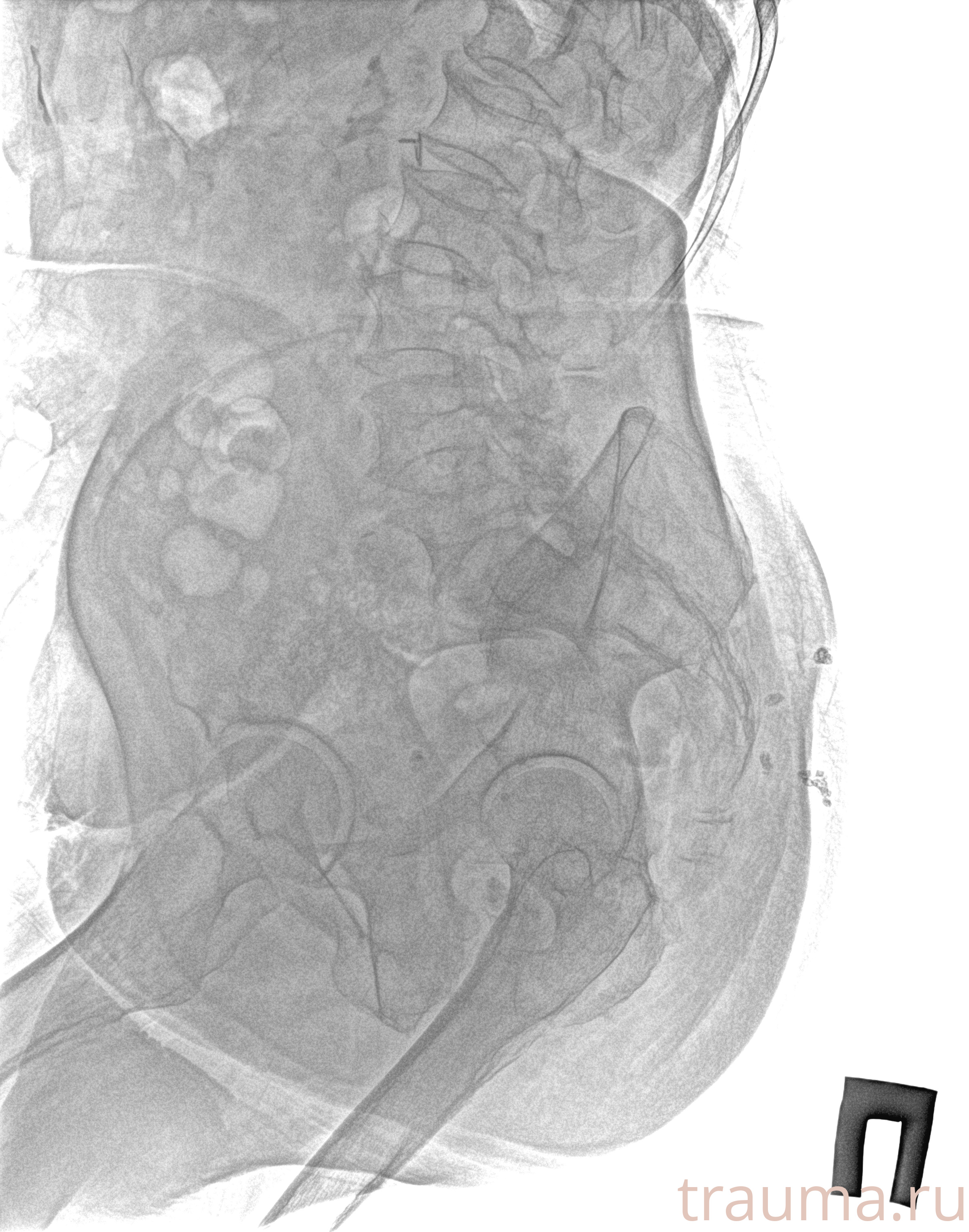 Рентген на дому: по вашему адресу приезжает врач-рентгенолог, травматолог-ортопед с мобильным рентгеновским аппаратом, проводит диагностику травмы или заболевания, делает необходимые рентгенограммы, дает рекомендации по дальнейшему лечению. Получить качественные снимки в домашних условиях возможно благодаря уникальной методике, разработанной МосРентген Центром для института  Склифосовского