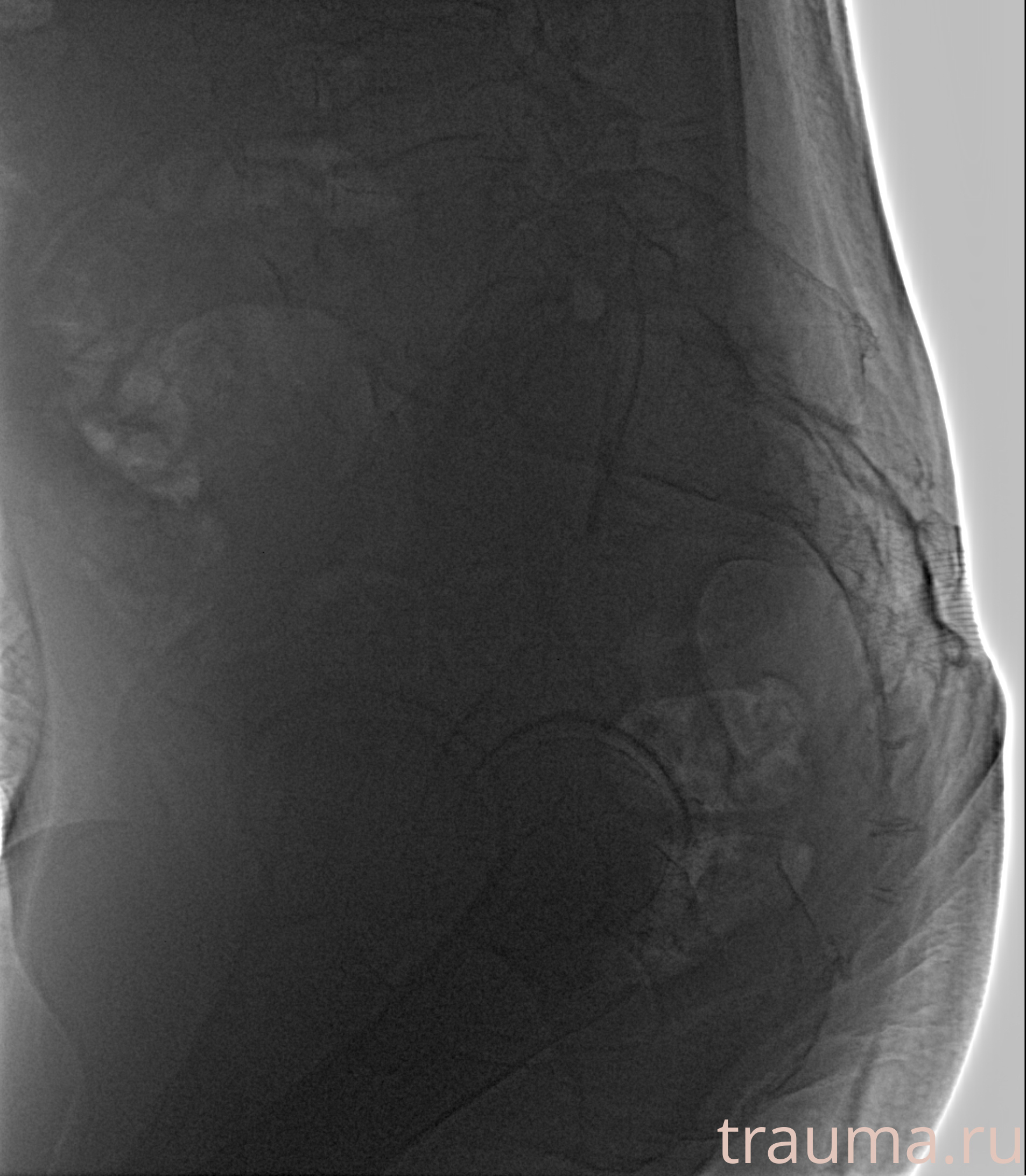 Рентген на дому: по вашему адресу приезжает врач-рентгенолог, травматолог-ортопед с мобильным рентгеновским аппаратом, проводит диагностику травмы или заболевания, делает необходимые рентгенограммы, дает рекомендации по дальнейшему лечению. Получить качественные снимки в домашних условиях возможно благодаря уникальной методике, разработанной МосРентген Центром для института  Склифосовского