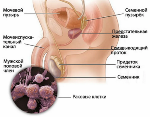 Рак полового члена
Рак полового члена