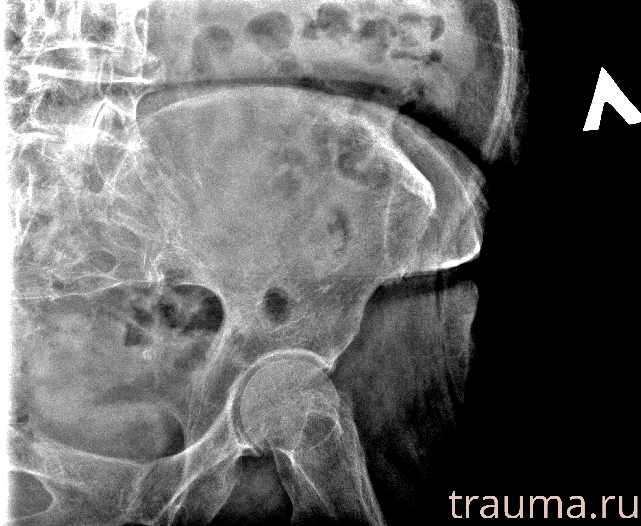 Рентген на дому: по вашему адресу приезжает врач-рентгенолог, травматолог-ортопед с мобильным рентгеновским аппаратом, проводит диагностику травмы или заболевания, делает необходимые рентгенограммы, дает рекомендации по дальнейшему лечению. Получить качественные снимки в домашних условиях возможно благодаря уникальной методике, разработанной МосРентген Центром для института  Склифосовского