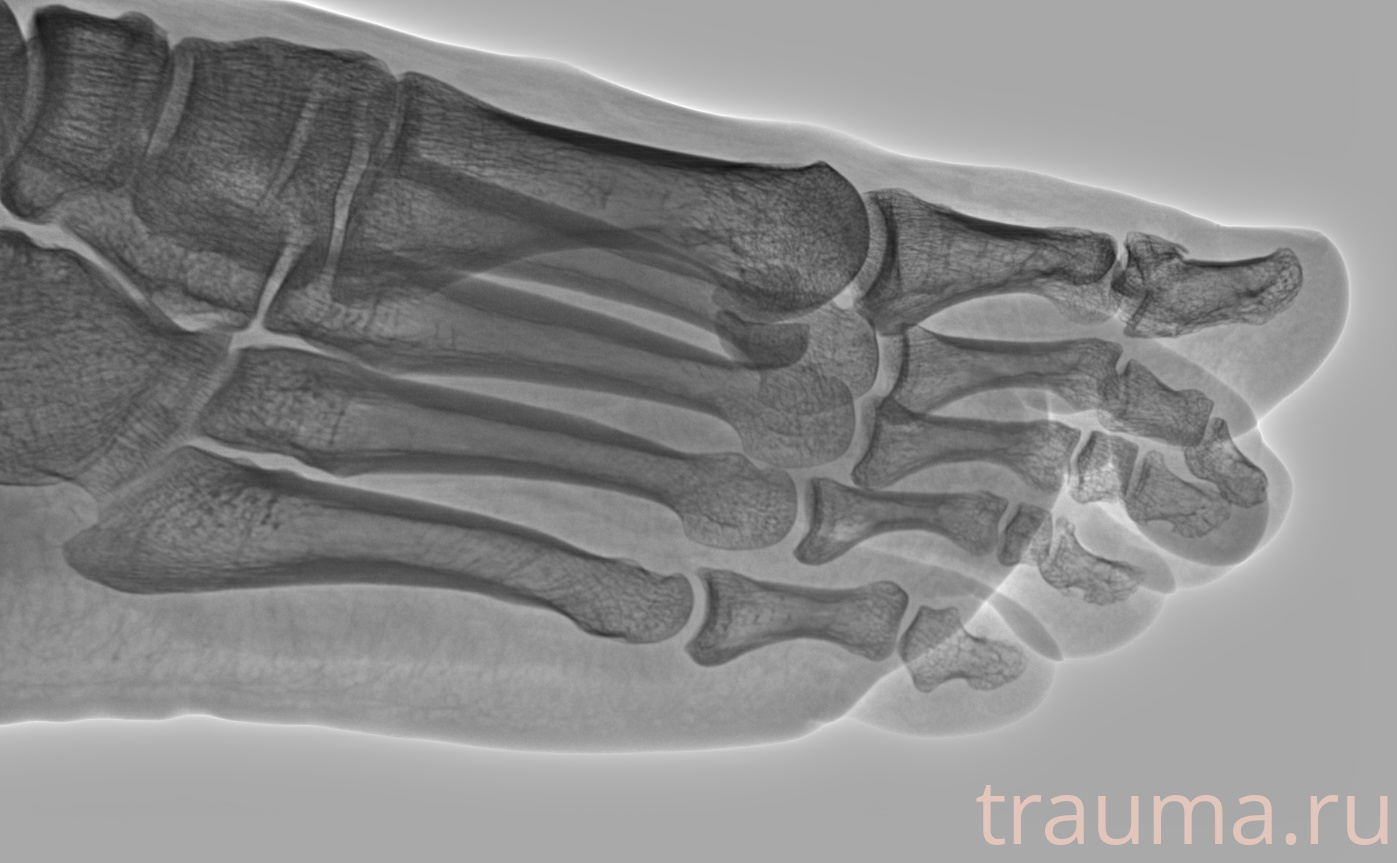 Рентген на дому: по вашему адресу приезжает врач-рентгенолог, травматолог-ортопед с мобильным рентгеновским аппаратом, проводит диагностику травмы или заболевания, делает необходимые рентгенограммы, дает рекомендации по дальнейшему лечению. Получить качественные снимки в домашних условиях возможно благодаря уникальной методике, разработанной МосРентген Центром для института  Склифосовского