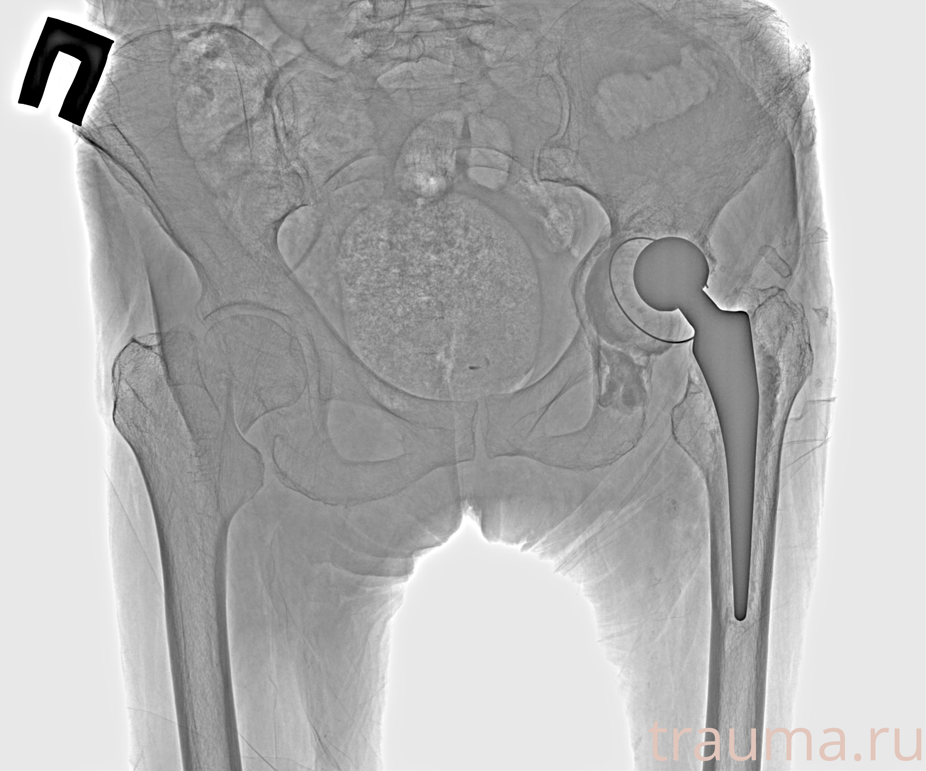 Рентген на дому: по вашему адресу приезжает врач-рентгенолог, травматолог-ортопед с мобильным рентгеновским аппаратом, проводит диагностику травмы или заболевания, делает необходимые рентгенограммы, дает рекомендации по дальнейшему лечению. Получить качественные снимки в домашних условиях возможно благодаря уникальной методике, разработанной МосРентген Центром для института  Склифосовского