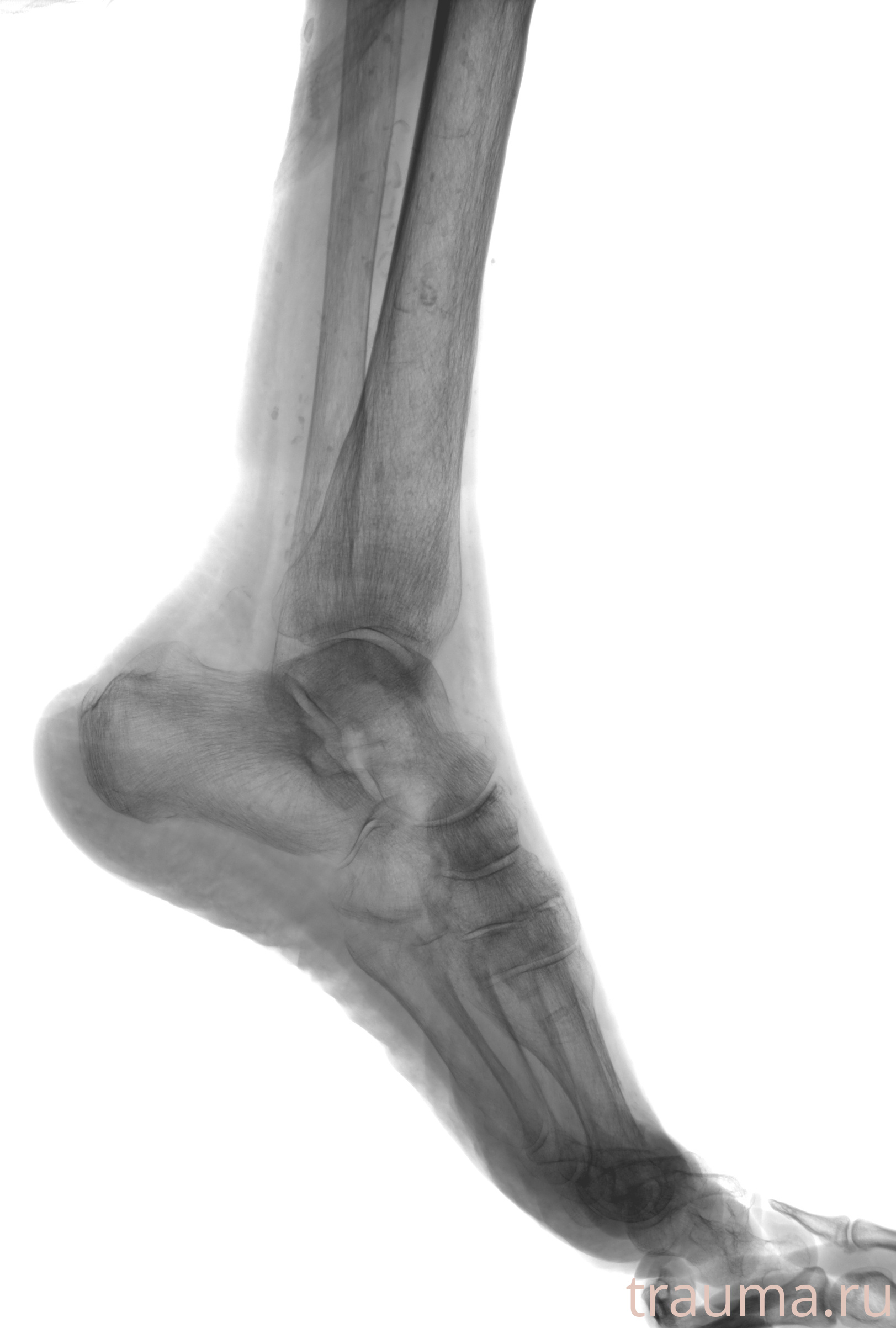 Рентген на дому: по вашему адресу приезжает врач-рентгенолог, травматолог-ортопед с мобильным рентгеновским аппаратом, проводит диагностику травмы или заболевания, делает необходимые рентгенограммы, дает рекомендации по дальнейшему лечению. Получить качественные снимки в домашних условиях возможно благодаря уникальной методике, разработанной МосРентген Центром для института  Склифосовского