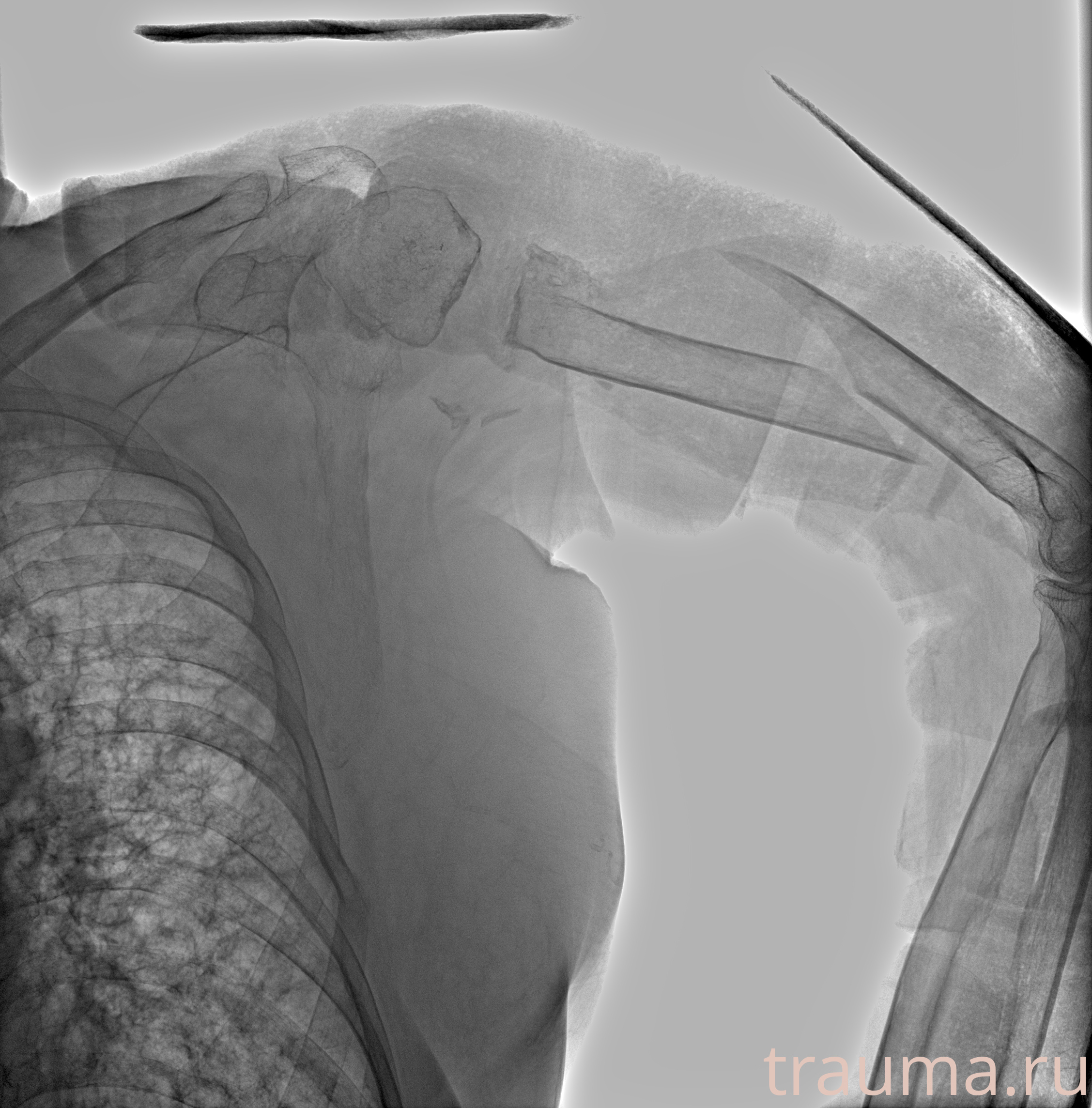 Рентген на дому: по вашему адресу приезжает врач-рентгенолог, травматолог-ортопед с мобильным рентгеновским аппаратом, проводит диагностику травмы или заболевания, делает необходимые рентгенограммы, дает рекомендации по дальнейшему лечению. Получить качественные снимки в домашних условиях возможно благодаря уникальной методике, разработанной МосРентген Центром для института  Склифосовского