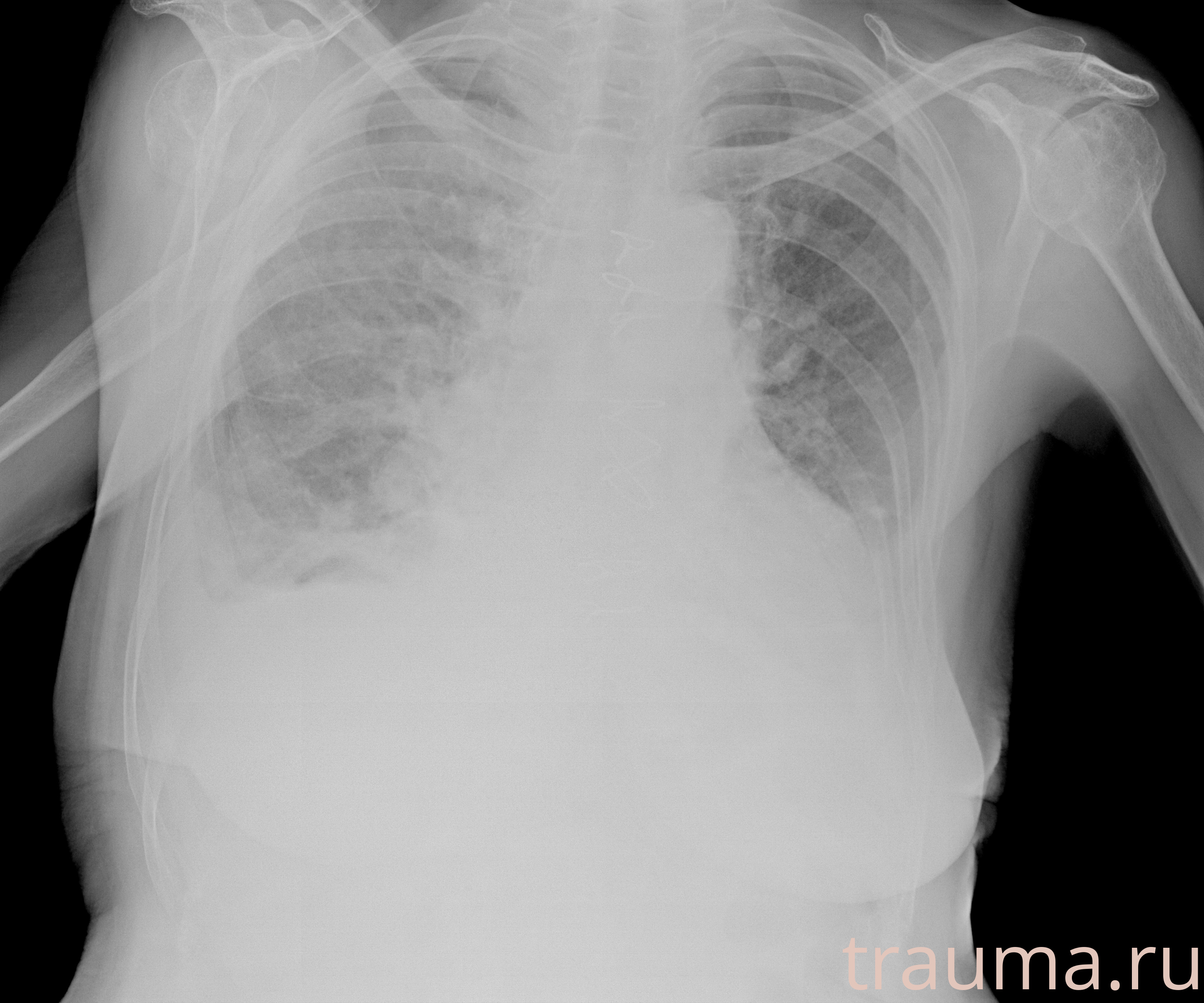 Рентген на дому: по вашему адресу приезжает врач-рентгенолог, травматолог-ортопед с мобильным рентгеновским аппаратом, проводит диагностику травмы или заболевания, делает необходимые рентгенограммы, дает рекомендации по дальнейшему лечению. Получить качественные снимки в домашних условиях возможно благодаря уникальной методике, разработанной МосРентген Центром для института  Склифосовского