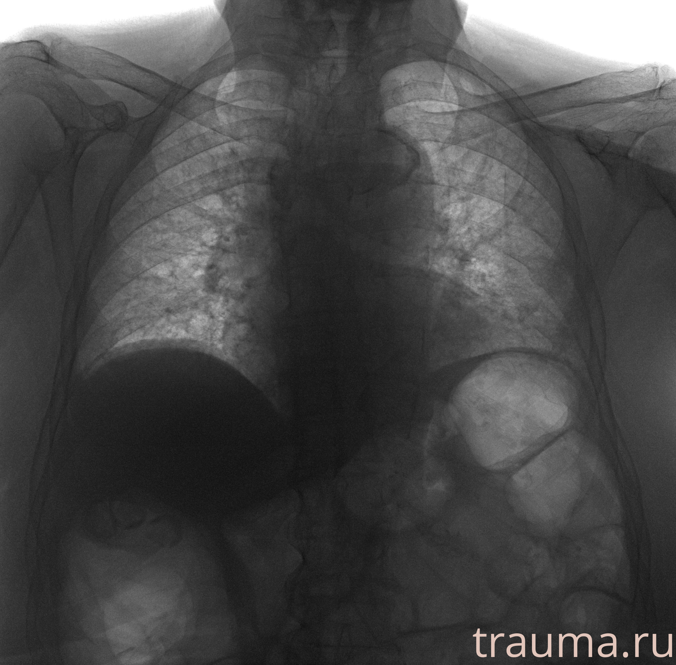 Рентген на дому: по вашему адресу приезжает врач-рентгенолог, травматолог-ортопед с мобильным рентгеновским аппаратом, проводит диагностику травмы или заболевания, делает необходимые рентгенограммы, дает рекомендации по дальнейшему лечению. Получить качественные снимки в домашних условиях возможно благодаря уникальной методике, разработанной МосРентген Центром для института  Склифосовского